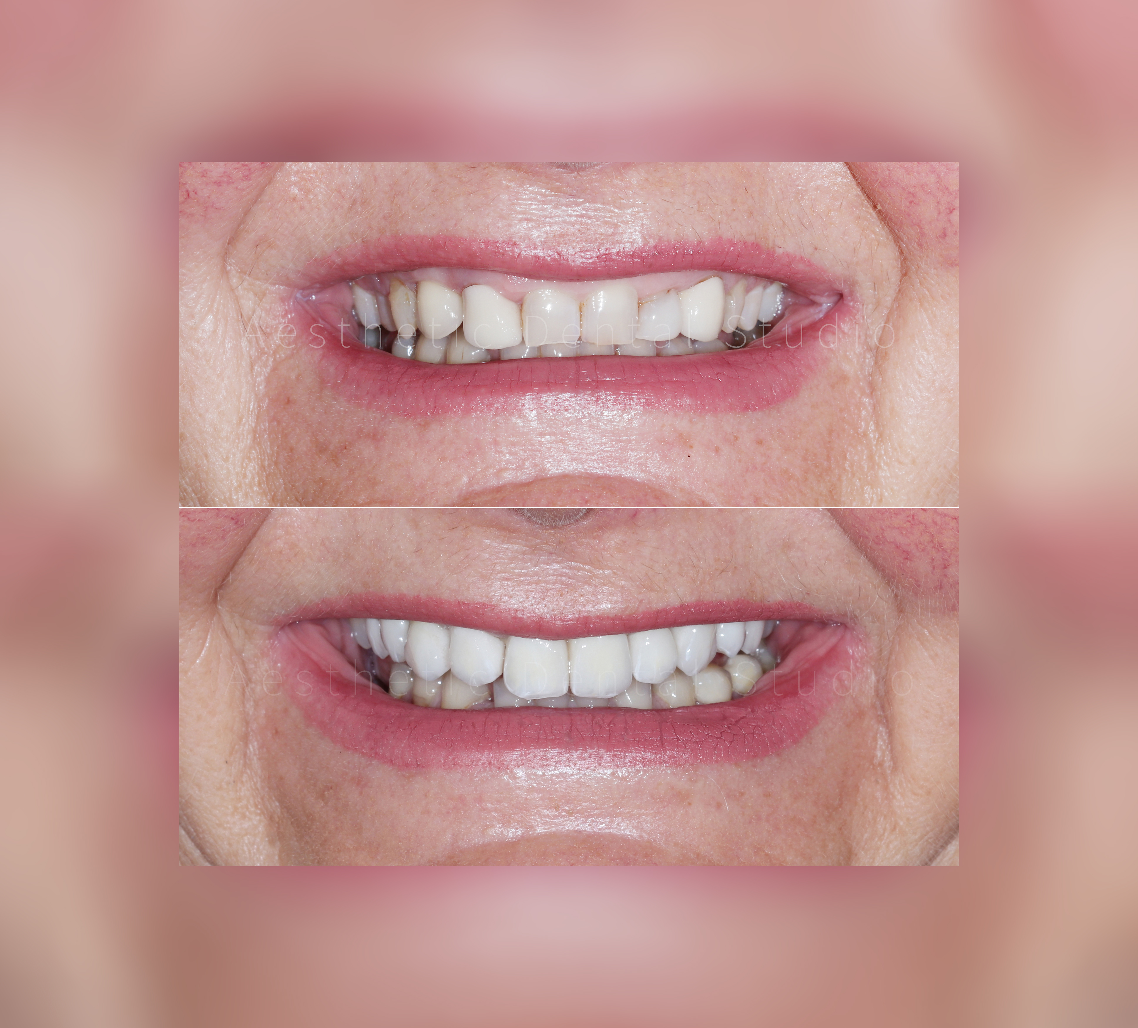 Αισθητική βελτίωση με ζιρκόνιο – Από το πριν στο μετά