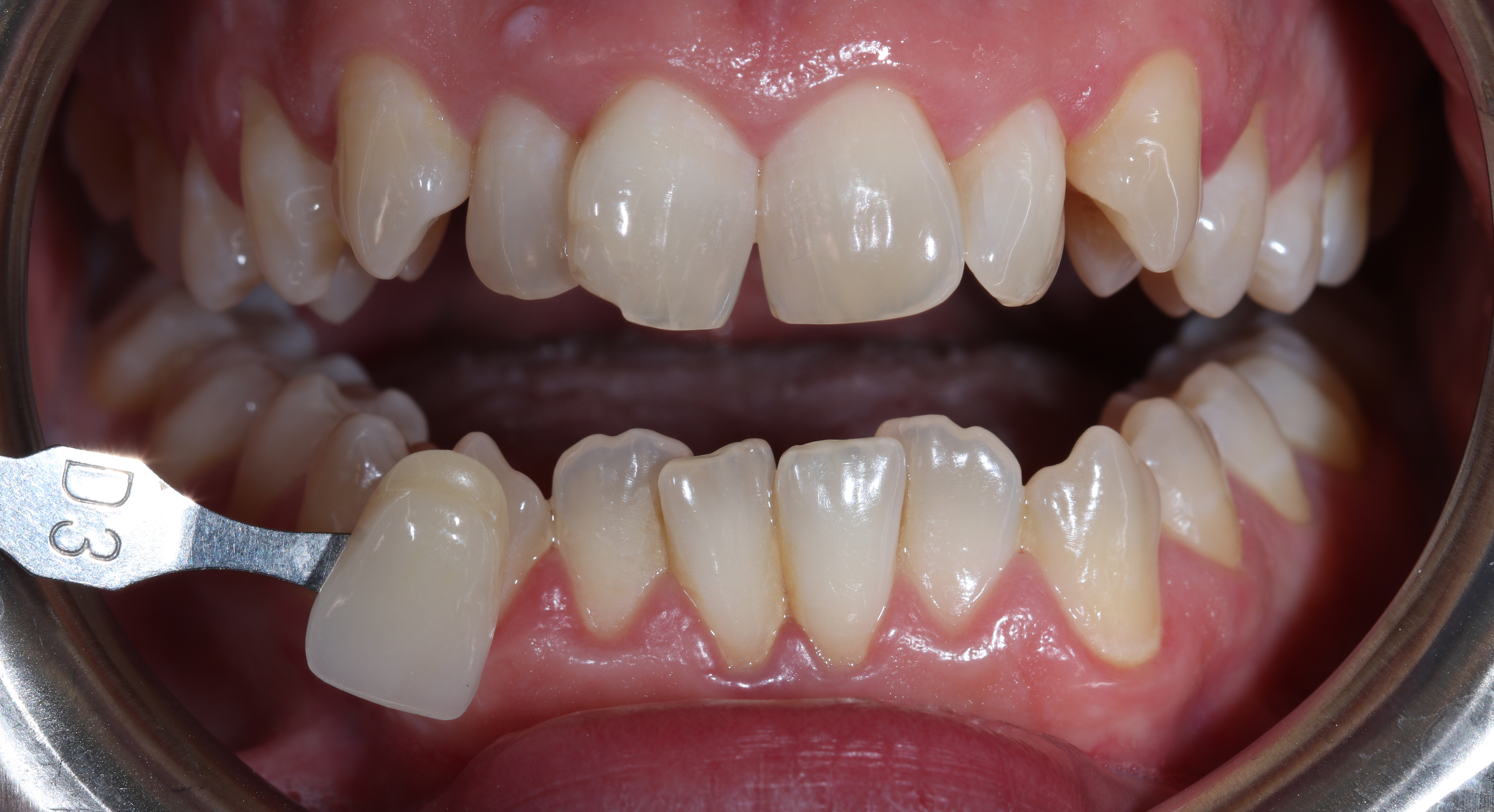 Αρχική κατάσταση - Το χρώμα των δοντιών πριν από την λεύκανση