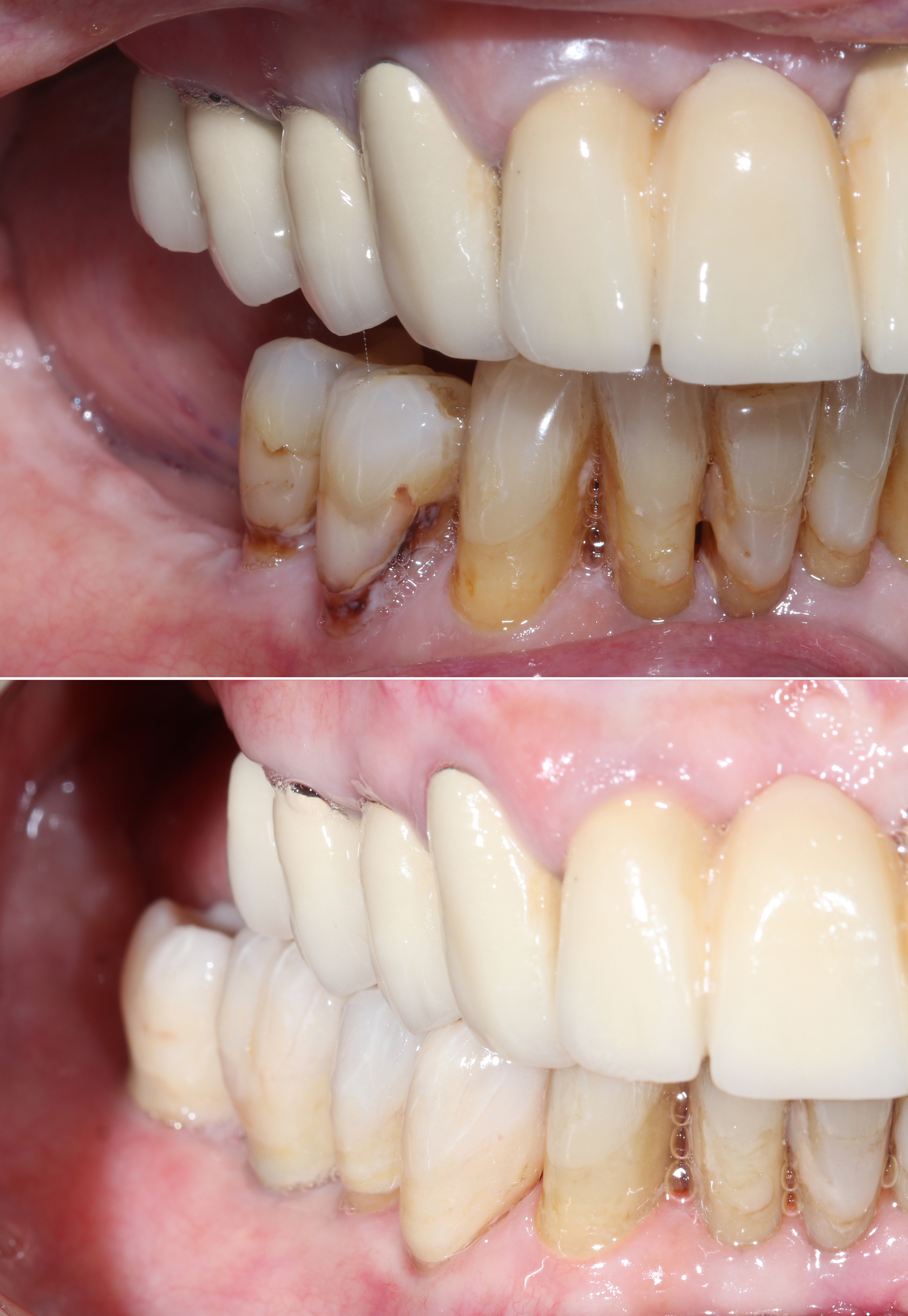 Σύγκριση αρχικής και τελικής κατάστασης – Πλάγια άποψη του στόματος πριν και μετά την αποκατάσταση
