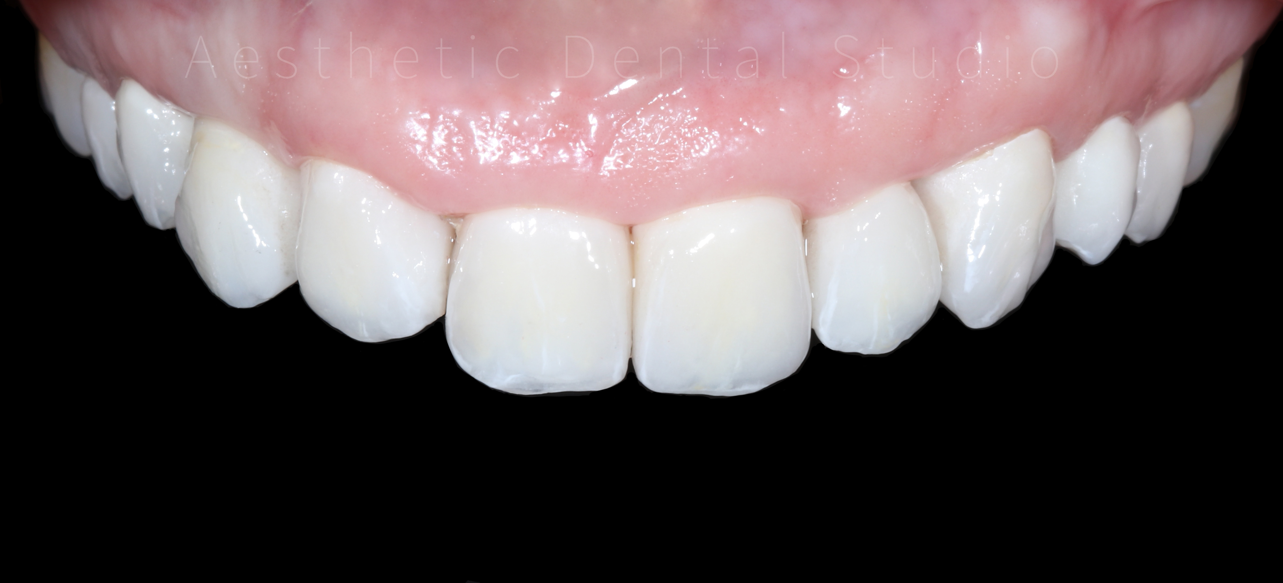 Κοντινή άποψη των ολοκεραμικών αποκαταστάσεων – Απόλυτη συμμετρία, φυσικές μεταβάσεις και ρεαλιστική υφή επιφανειών για ένα χαμόγελο υψηλής αισθητικής και φυσικότητας