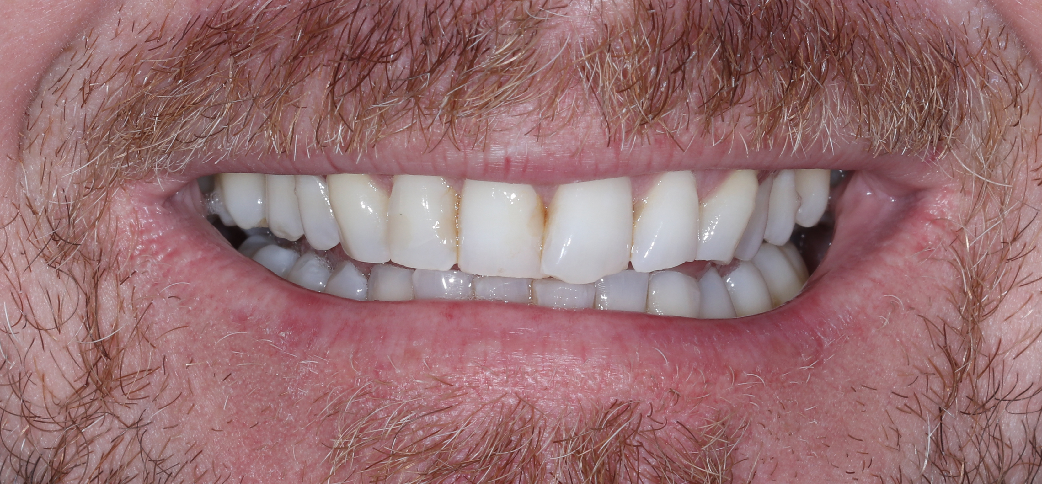 Χαμόγελο πριν την έναρξη της θεραπείας - Συνωστισμός στους κεντρικούς τομείς και αποτριβές των άνω πρόσθιων δοντιών