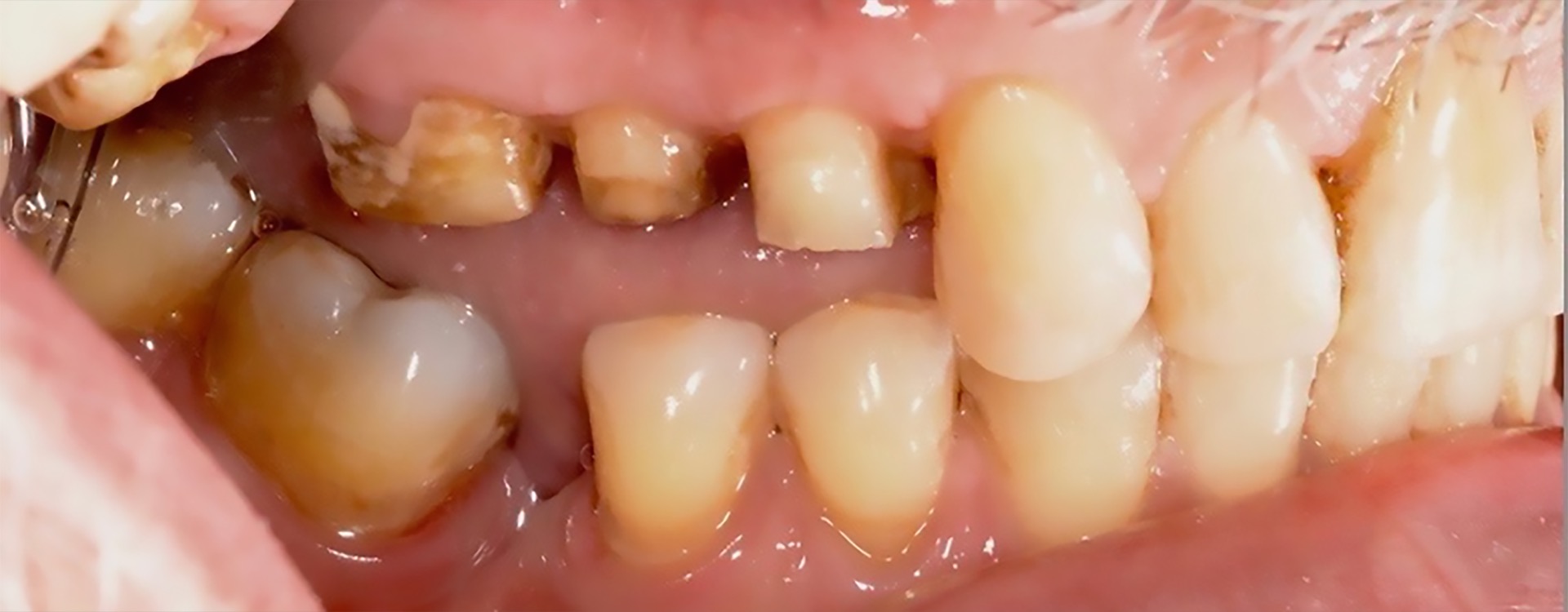 Τρεις μήνες μετά την χειρουργική αποκάλυψη των άνω δεξιά οπίσθιων δοντιών - Συγκριτικά με την προτέρα κατάσταση, τα δόντια τώρα έχουν επαρκές ύψος για να στηρίξουν τις αποκαταστάσεις.