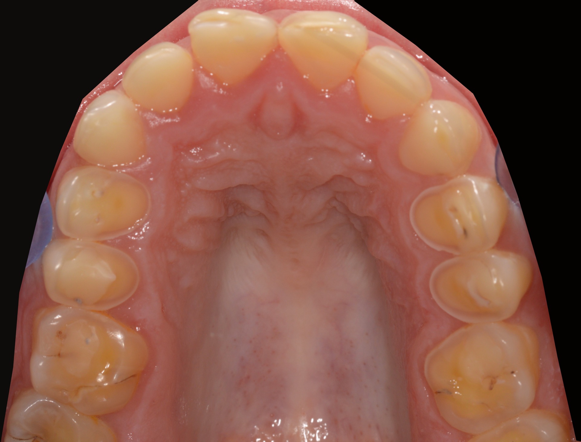 Αρχική κατάσταση - Μασητική άποψη (άνω γνάθος).