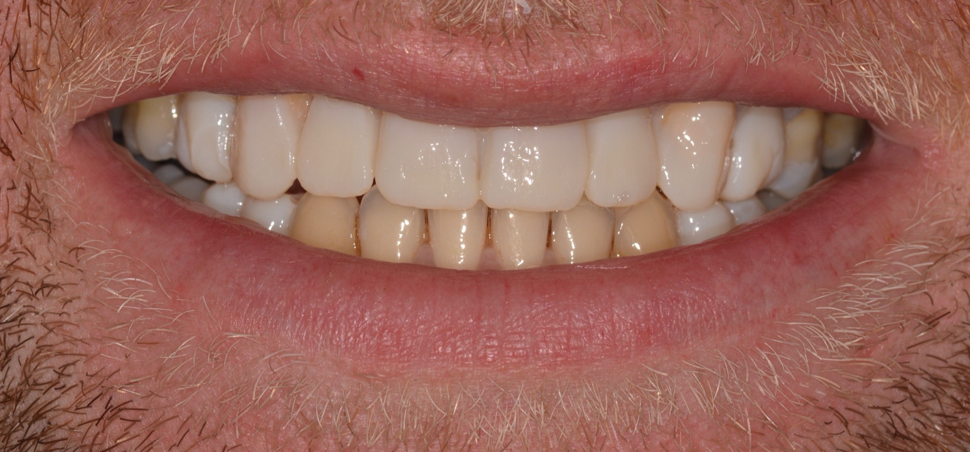 Προεπισκόπηση των τελικών αποκατάστασεων με πλαστικό αποκαταστατικό υλικό (mock-up). Ο ασθενής μπορεί να δει τις αλλαγές που θα κάνουμε στο χαμόγελό του, πριν ξεκινήσουμε την θεραπεία.