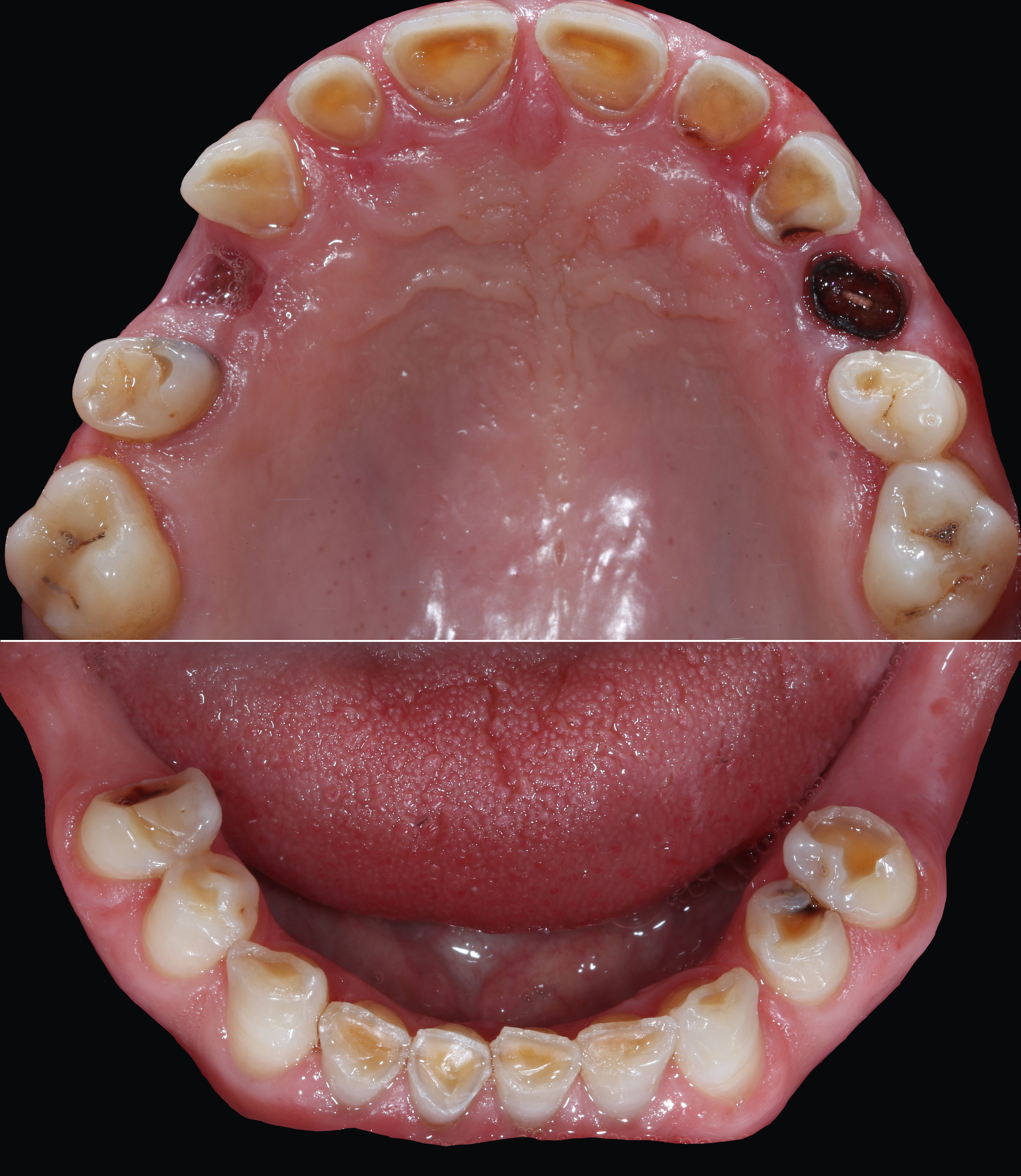 Αρχική κατάσταση - Μασητική άποψη άνω και κάτω γνάθων - Αραιοδοντία, εκτεταμένη οδοντική φθορά (διαβρώσεις και αποτριβές),  τερηδόνες και έλλειψη δοντιών