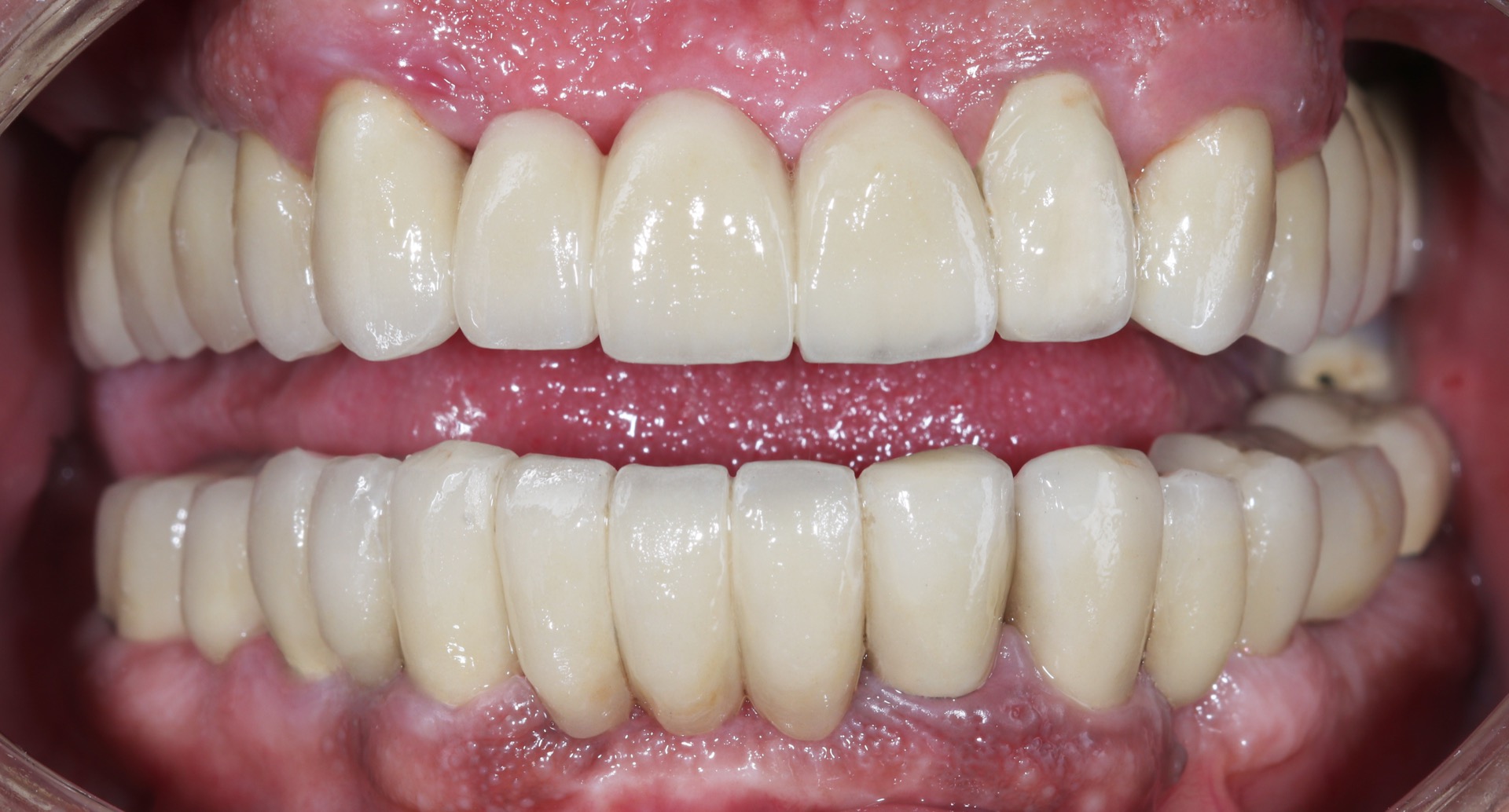 Τελική κατάσταση - Πρόσθια άποψη των αποκαταστάσεων (ελαφρώς ανοικτό στόμα).