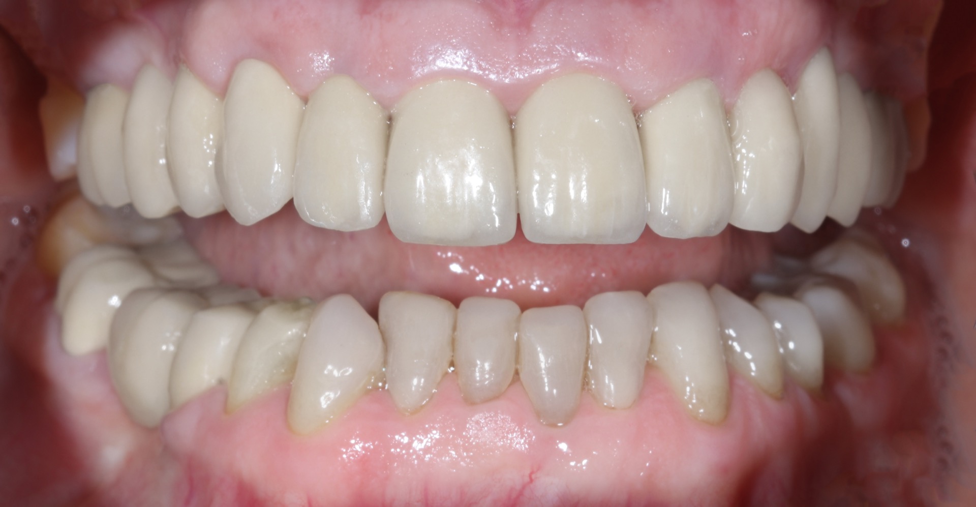 Τελική κατάσταση - Πρόσθια άποψη των αποκαταστάσεων τοποθετημένων στο στόμα (ελαφρώς ανοικτό στόμα) - Αποκατάσταση της αισθητικής και της σύγκλεισης της ασθενούς.
