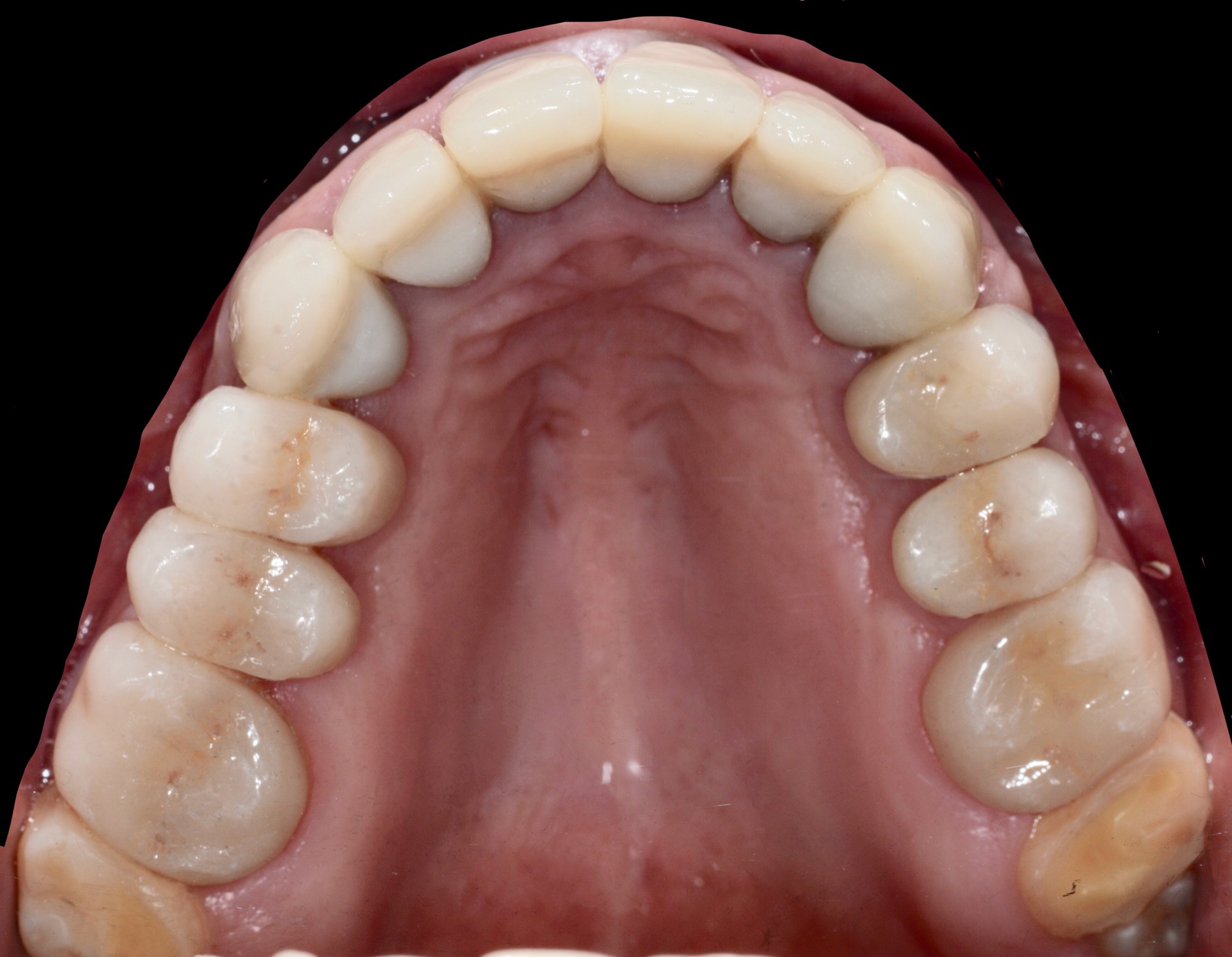 Τελική κατάσταση - Μασητική άποψη (άνω γνάθος)