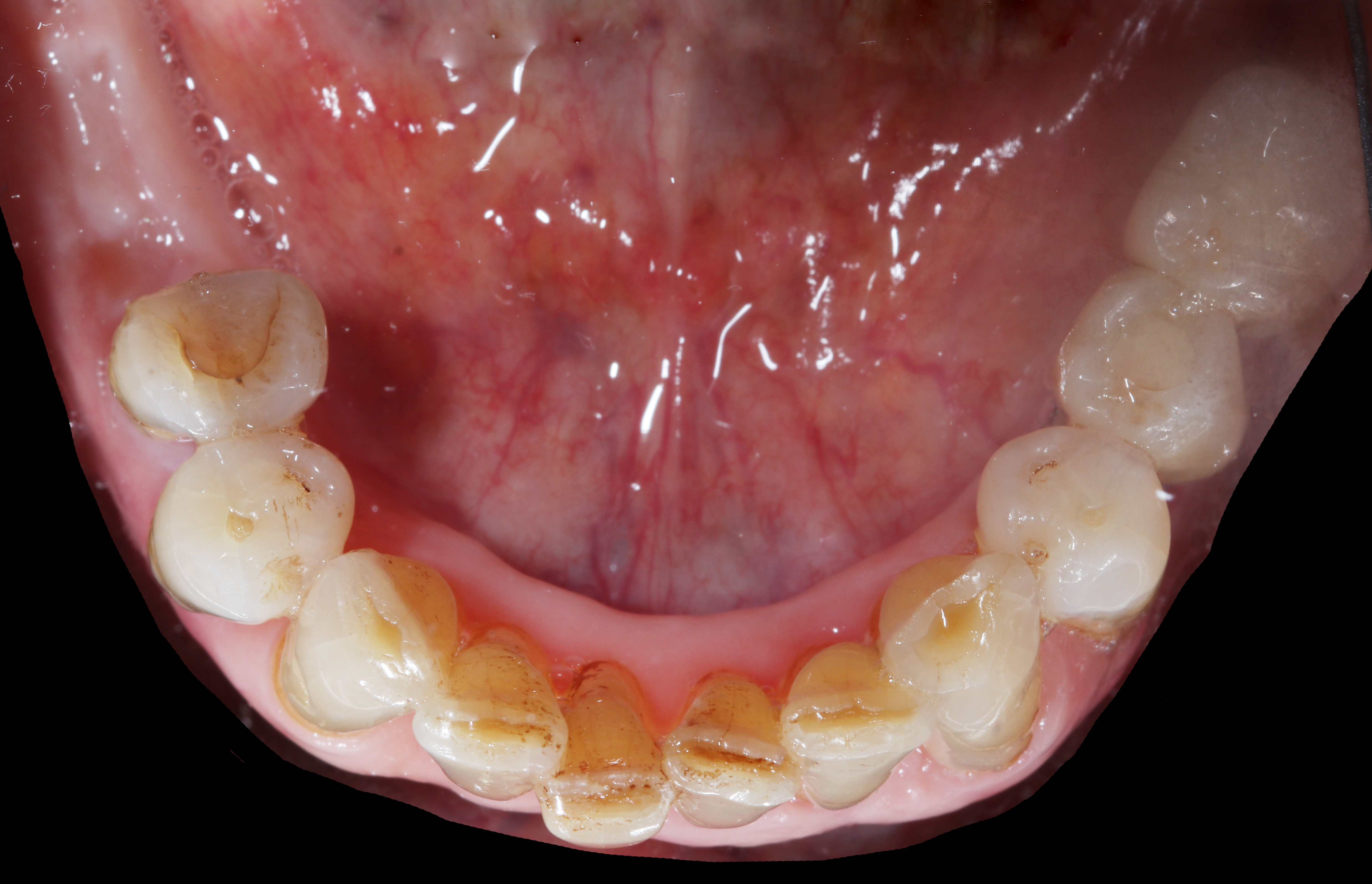 Αρχική κατάσταση - Μασητική άποψη