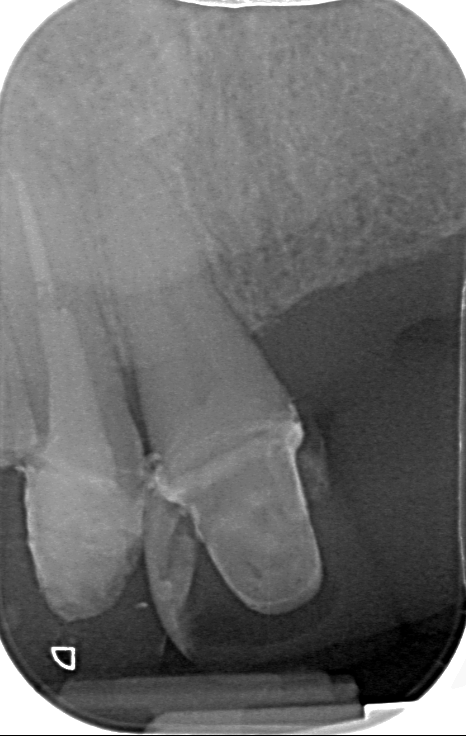 Τελική κατάσταση Τελική κατάσταση