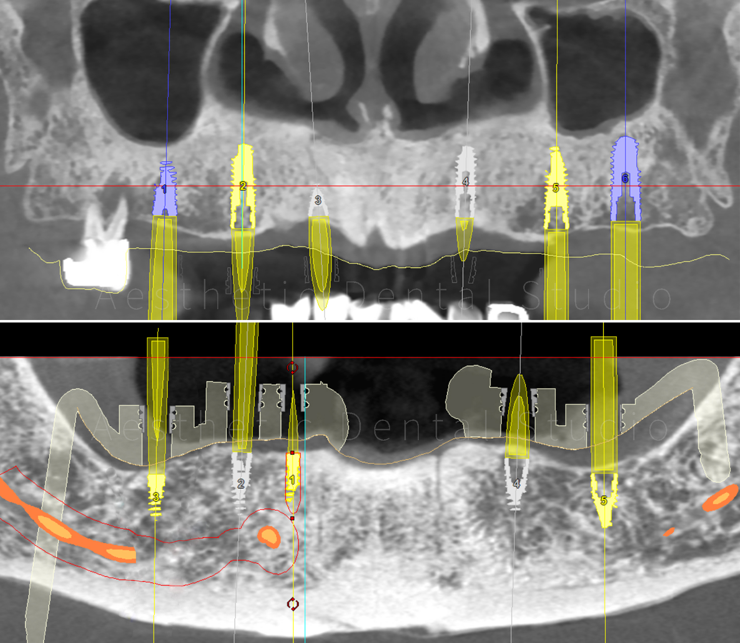 Ψηφιακός προεγχειρητικός σχεδιασμός — εικονική τοποθέτηση εμφυτευμάτων με τη βοήθεια εξειδικευμένου λογισμικού για μέγιστη ακρίβεια