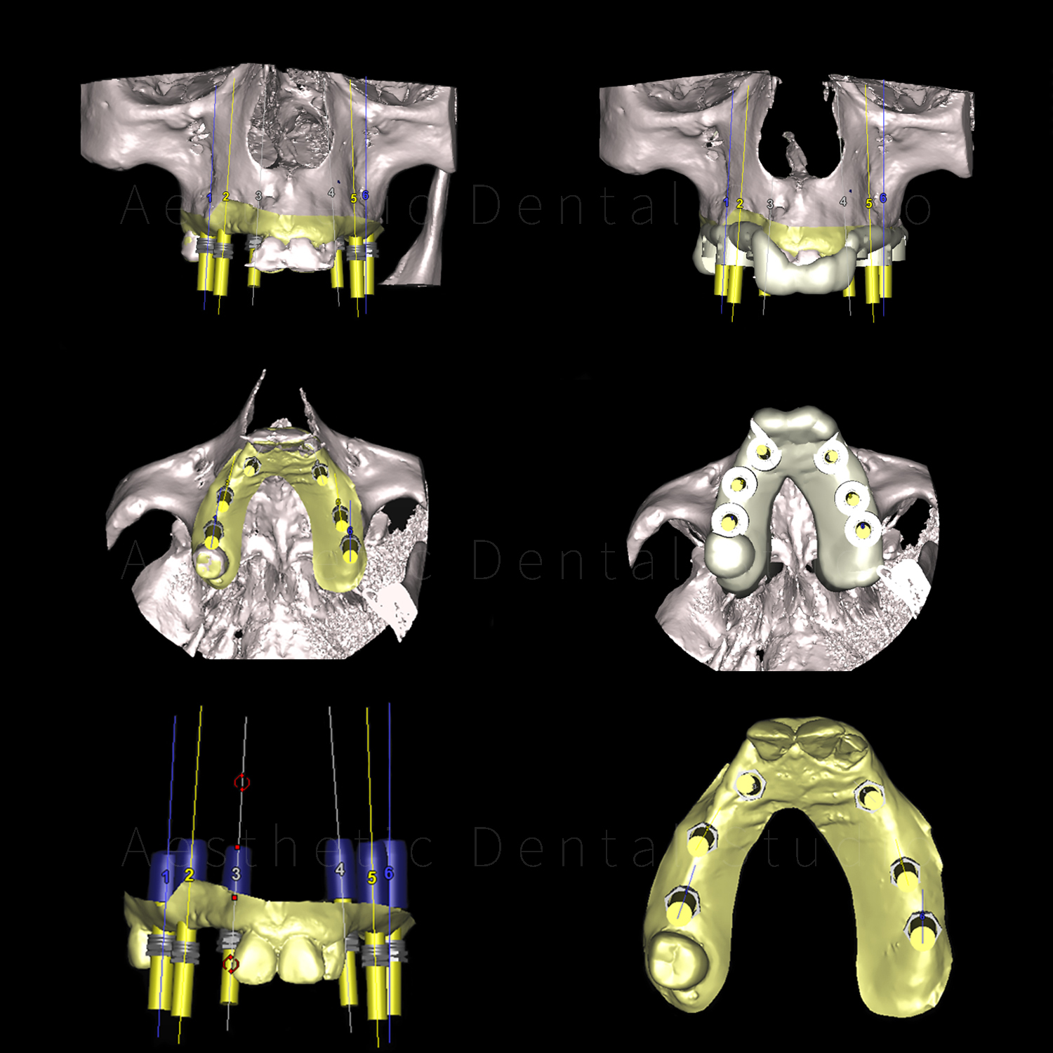Τρισδιάστατος ψηφιακός σχεδιασμός και δημιουργία χειρουργικού οδηγού — εξατομικευμένος οδηγός για ακριβή τοποθέτηση εμφυτευμάτων σύμφωνα με το προεγχειρητικό πλάνο
