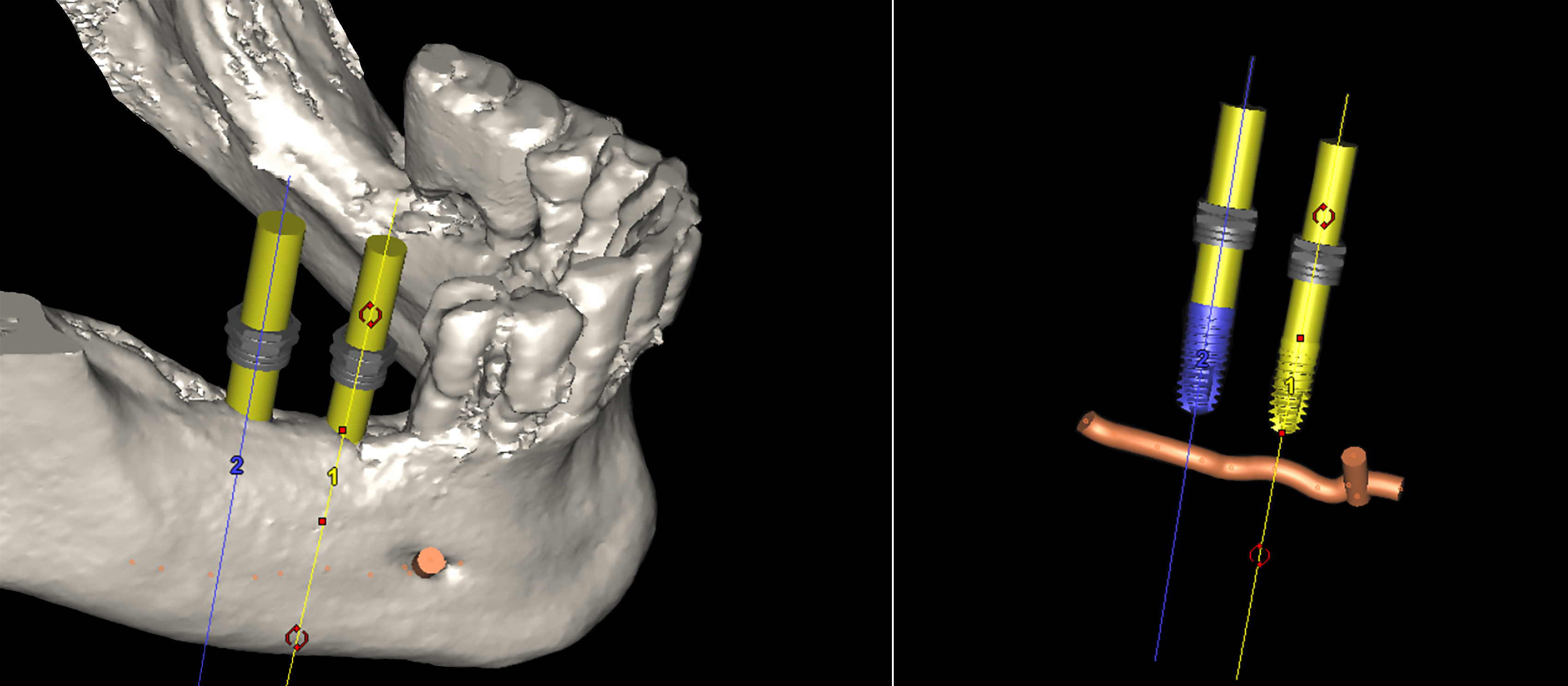 3D αξονική τομογραφία – Αριστερά: τρισδιάστατο μοντέλο του οστού της κάτω γνάθου με ψηφιακά τοποθετημένα τα δύο εμφυτεύματα.
Δεξιά: το ζωτικής σημασίας κάτω φατνιακό νεύρο και τα ψηφιακά ομοιώματα των εμφυτευμάτων. Η απόσταση από το νεύρο είναι επαρκής, επιτρέποντας την ασφαλή τοποθέτησή τους