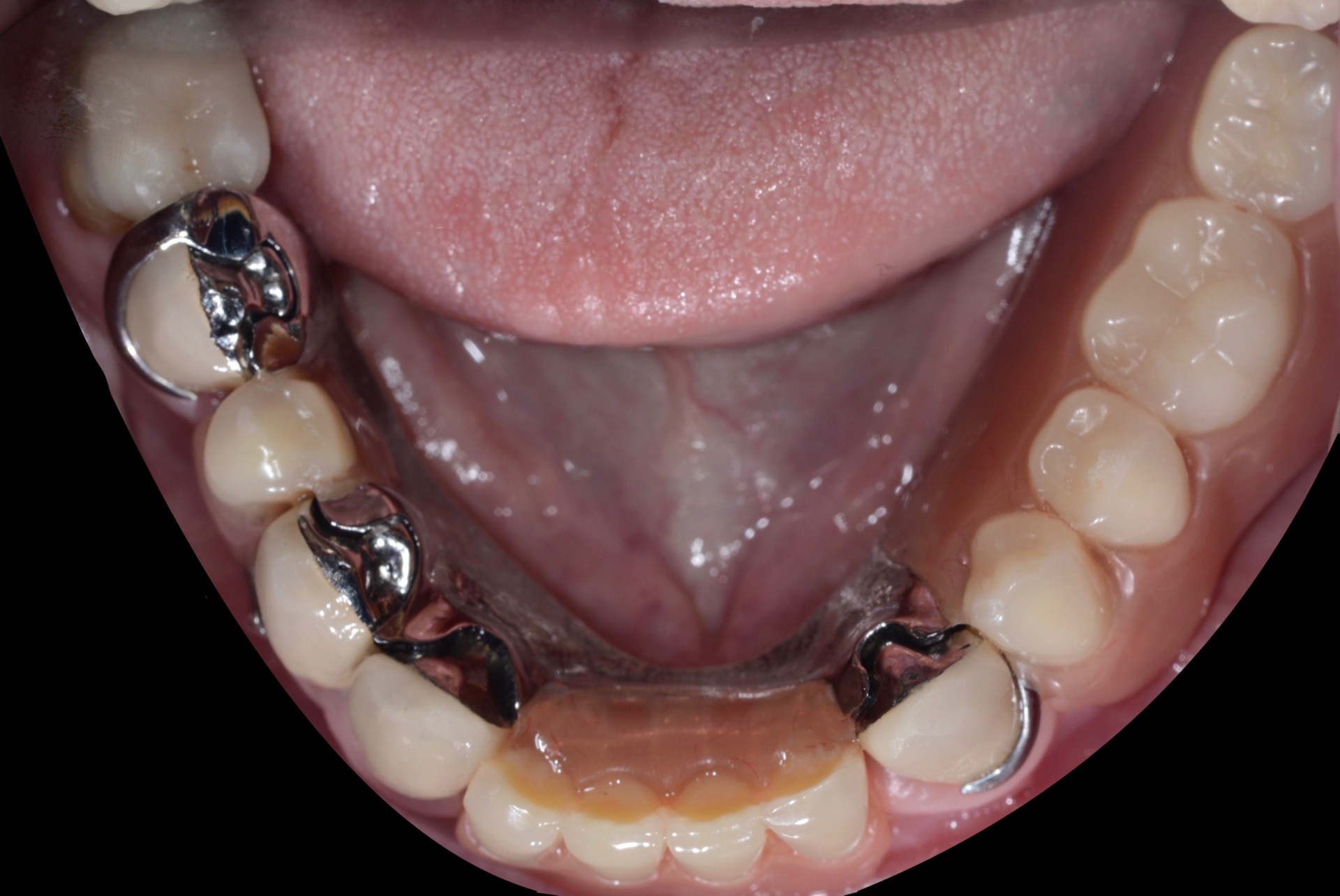 Τελική κατάσταση - Μασητική άποψη κάτω γνάθου (με την μερική οδοντοστοιχία τοποθετημένη