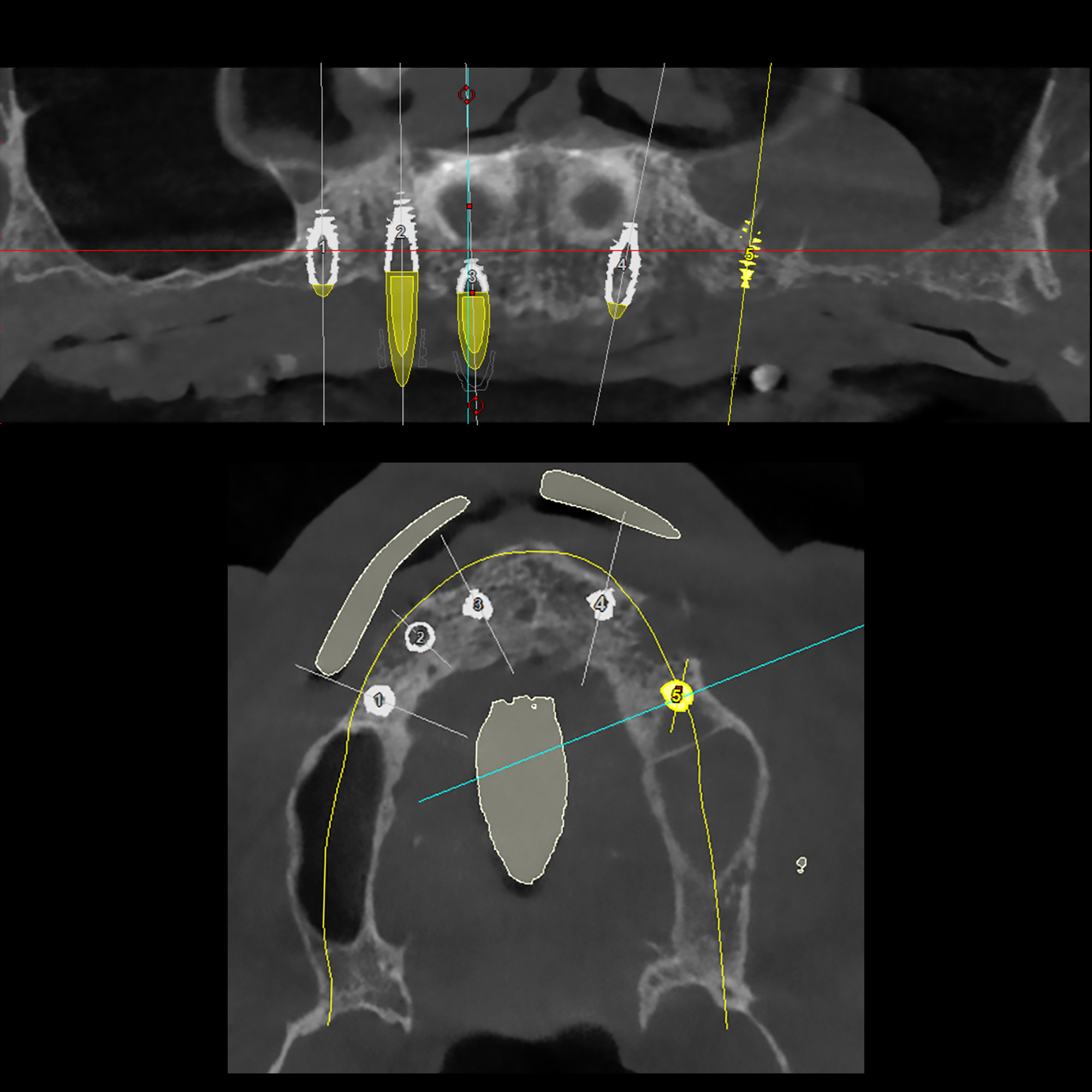 3D Αξονική ακτινογραφία - Πανοραμική και εγκάρσια τομή της άνω γνάθου της ασθενούς - Πέντε εμφυτεύματα έχουν τοποθετηθεί στις ιδανικότερες θέσεις της άνω γνάθου με την βοήθεια ειδικού οδοντιατρικού λογισμικού που χρησιμοποιούμε για τον χειρουργικό σχεδιασμό περιστατικών με εμφυτεύματα. Σε ένα από τα πέντε εμφυτεύματα έγινε ταυτόχρονη ανύψωση του ιγμορείου.