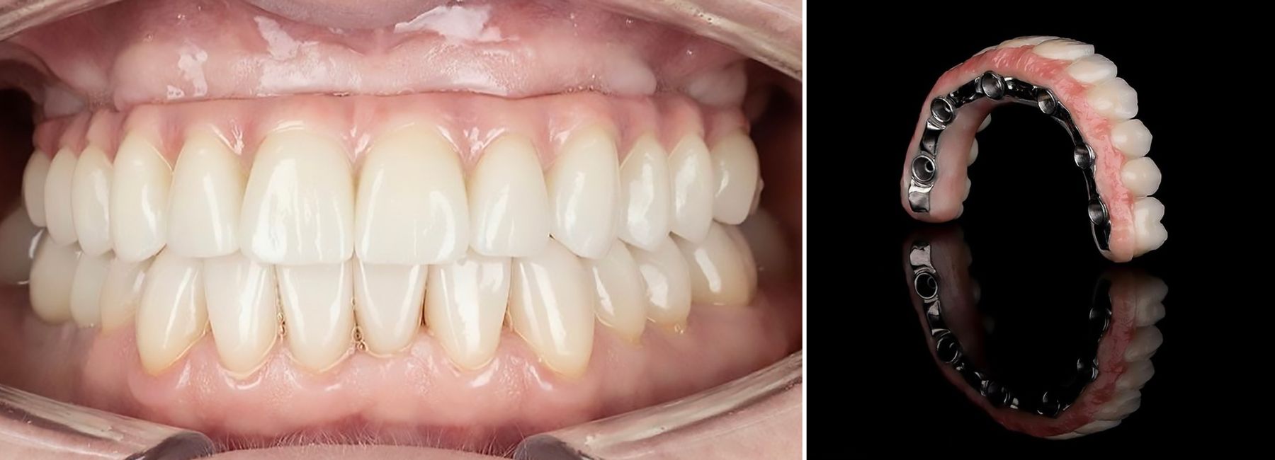 Full mouth implant reconstructions
