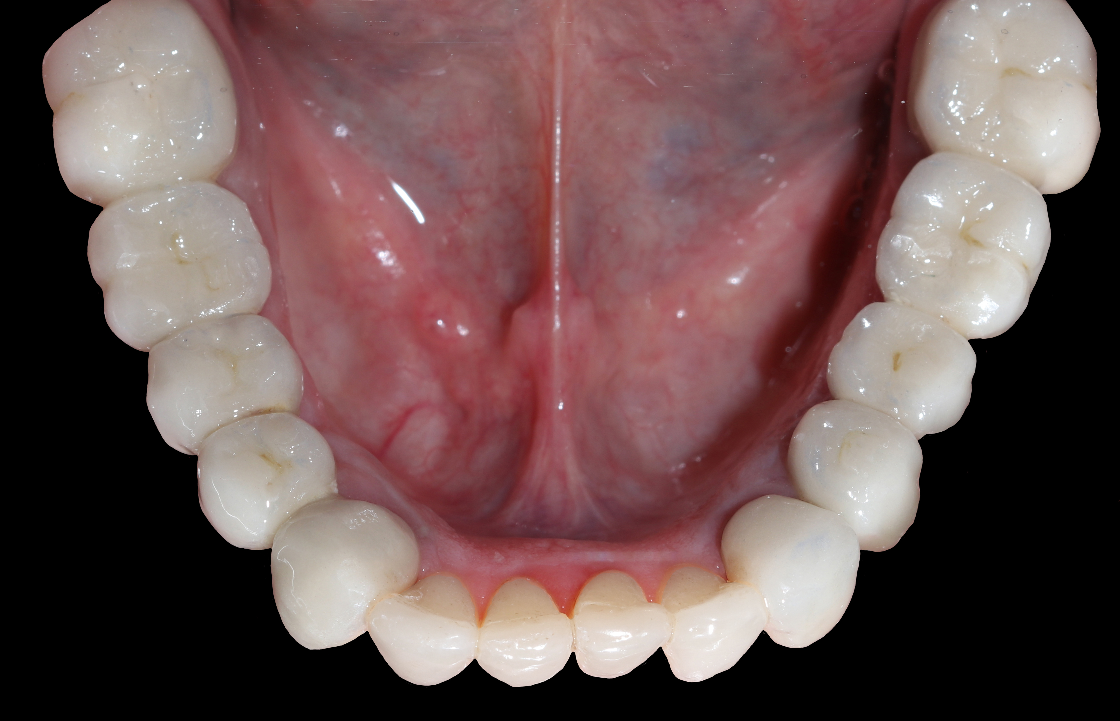 Κάτω γνάθος - Μασητική άποψη μετά την αποκατάσταση