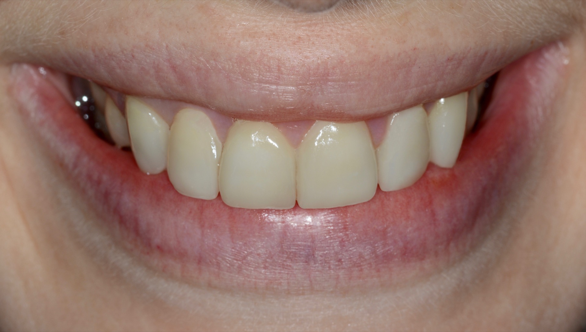 Τελική κατάσταση - Χαμόγελο.