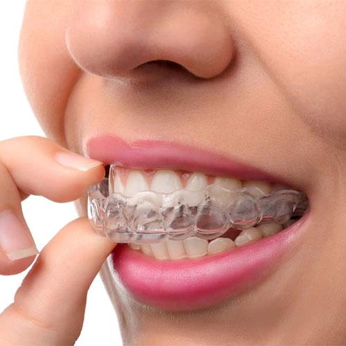Οι 3D printed clear aligners αποτελούν σύγχρονη λύση ψηφιακής ορθοδοντικής, προσφέροντας πιο άνετη, αισθητική και εξατομικευμένη μετακίνηση δοντιών.