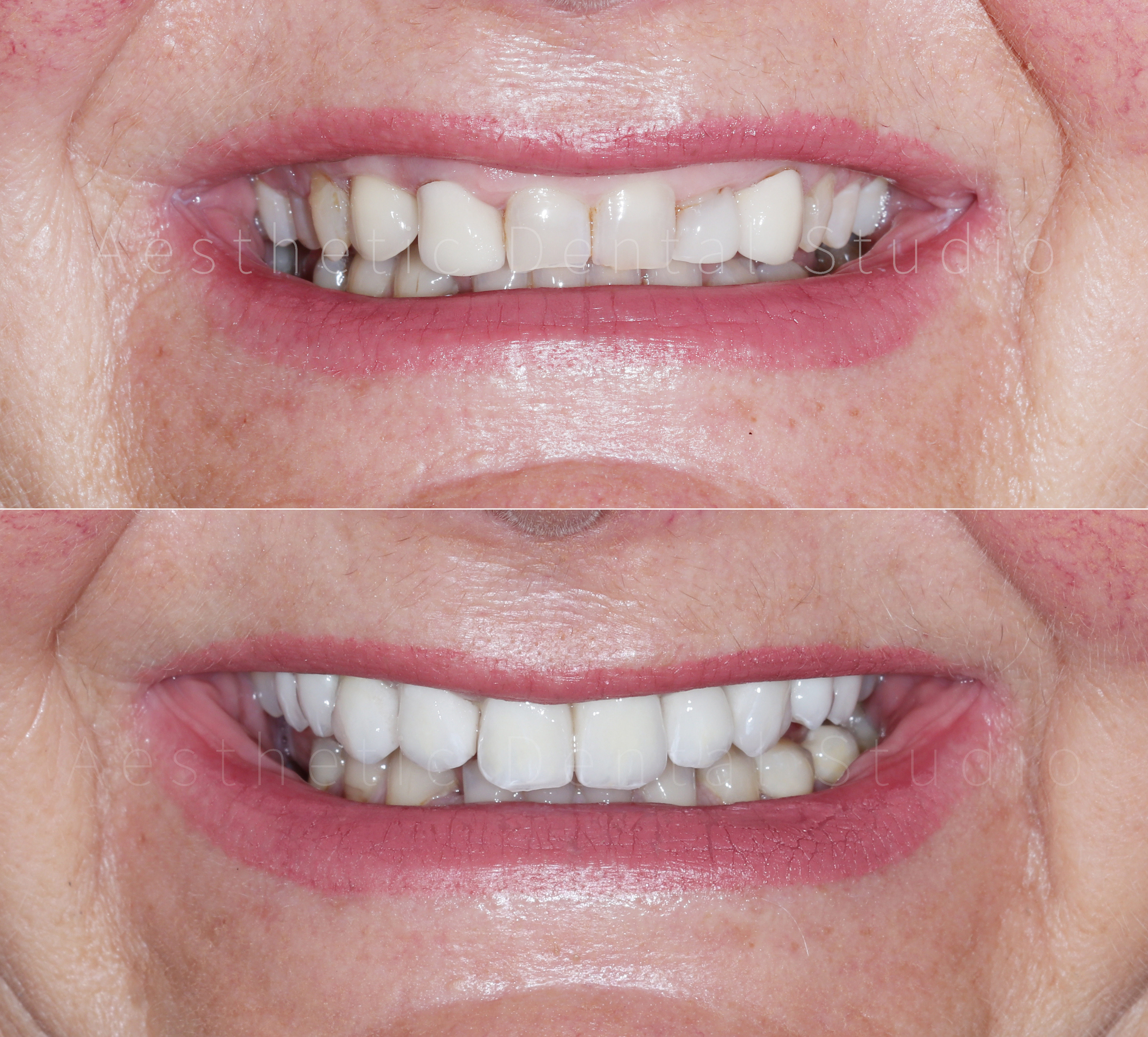 Αισθητική μεταμόρφωση χαμόγελου – Ολική αποκατάσταση των άνω προσθίων δοντιών με ολοκεραμικές στεφάνες και όψεις, για ένα συμμετρικό, φωτεινό και φυσικό αποτέλεσμα