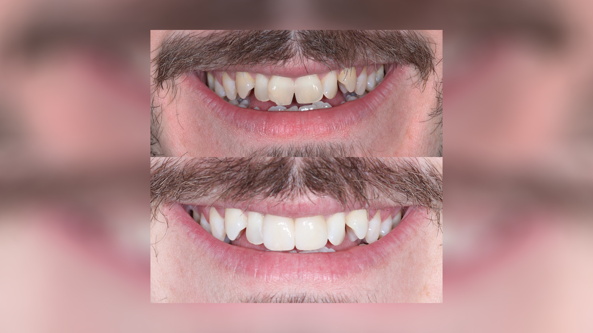 Porcelain veneers for correction of shape and crowding of upper central incisors - Dr. Klironomos