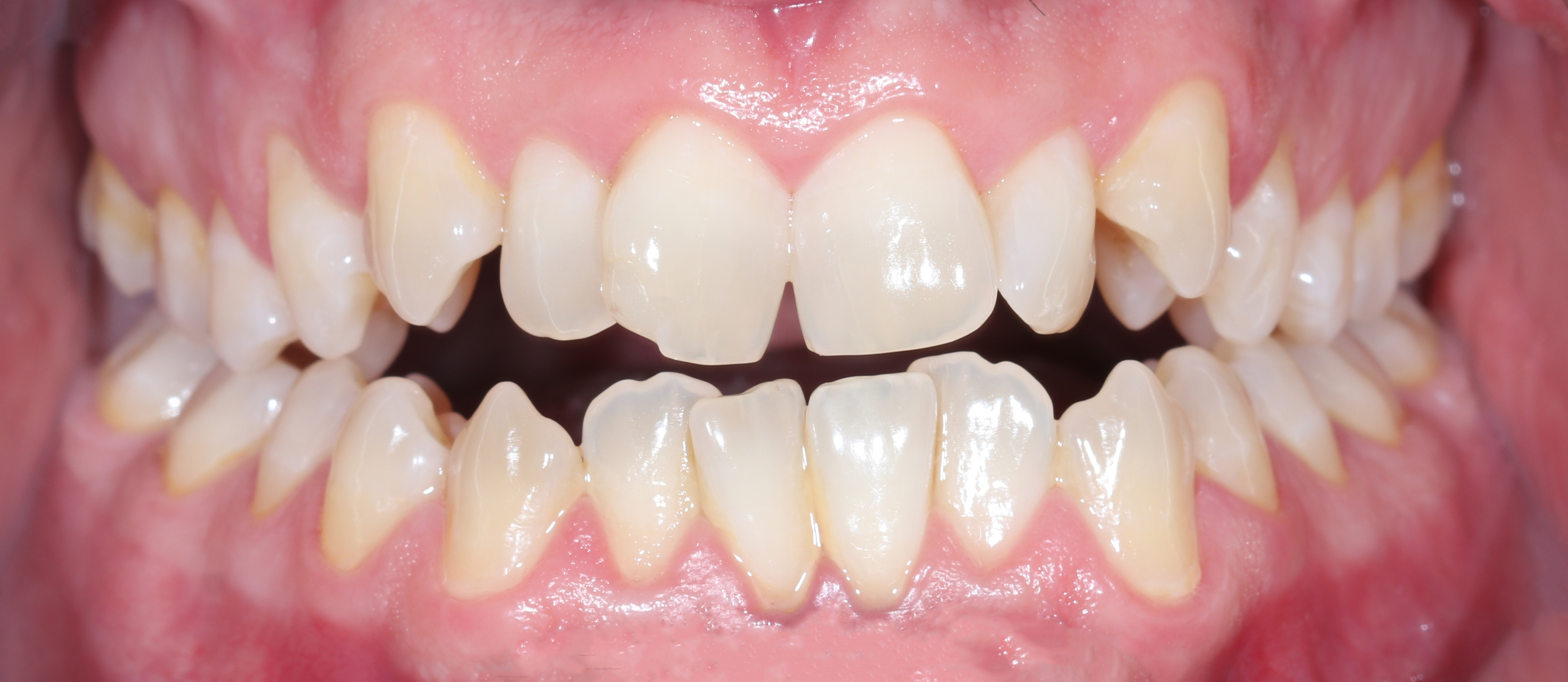 Αρχική κατάσταση - Πρόσθια άποψη με τα δόντια σε σύγκλειση