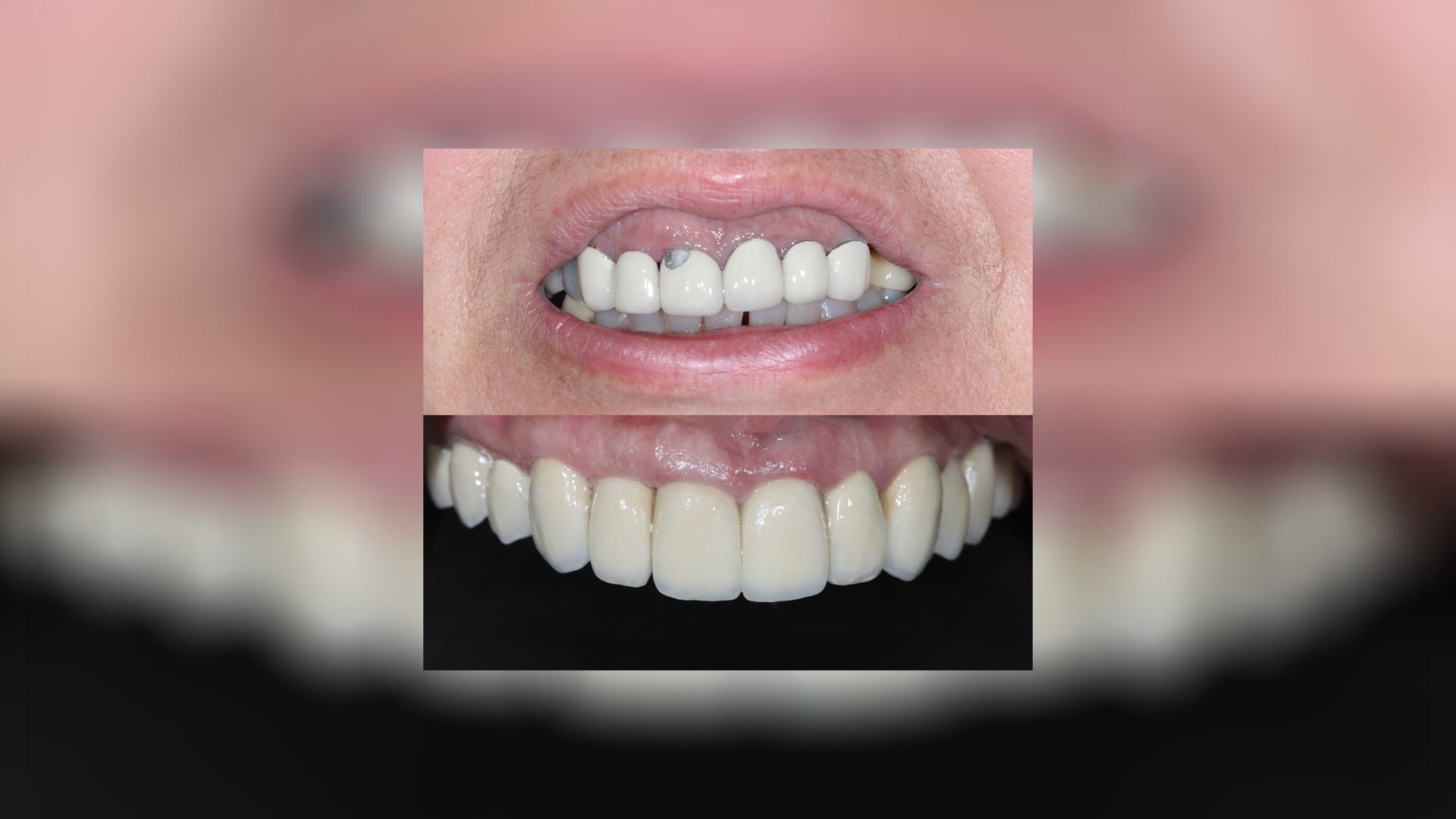Upper jaw restoration with ceramic crowns - Dr. Klironomos