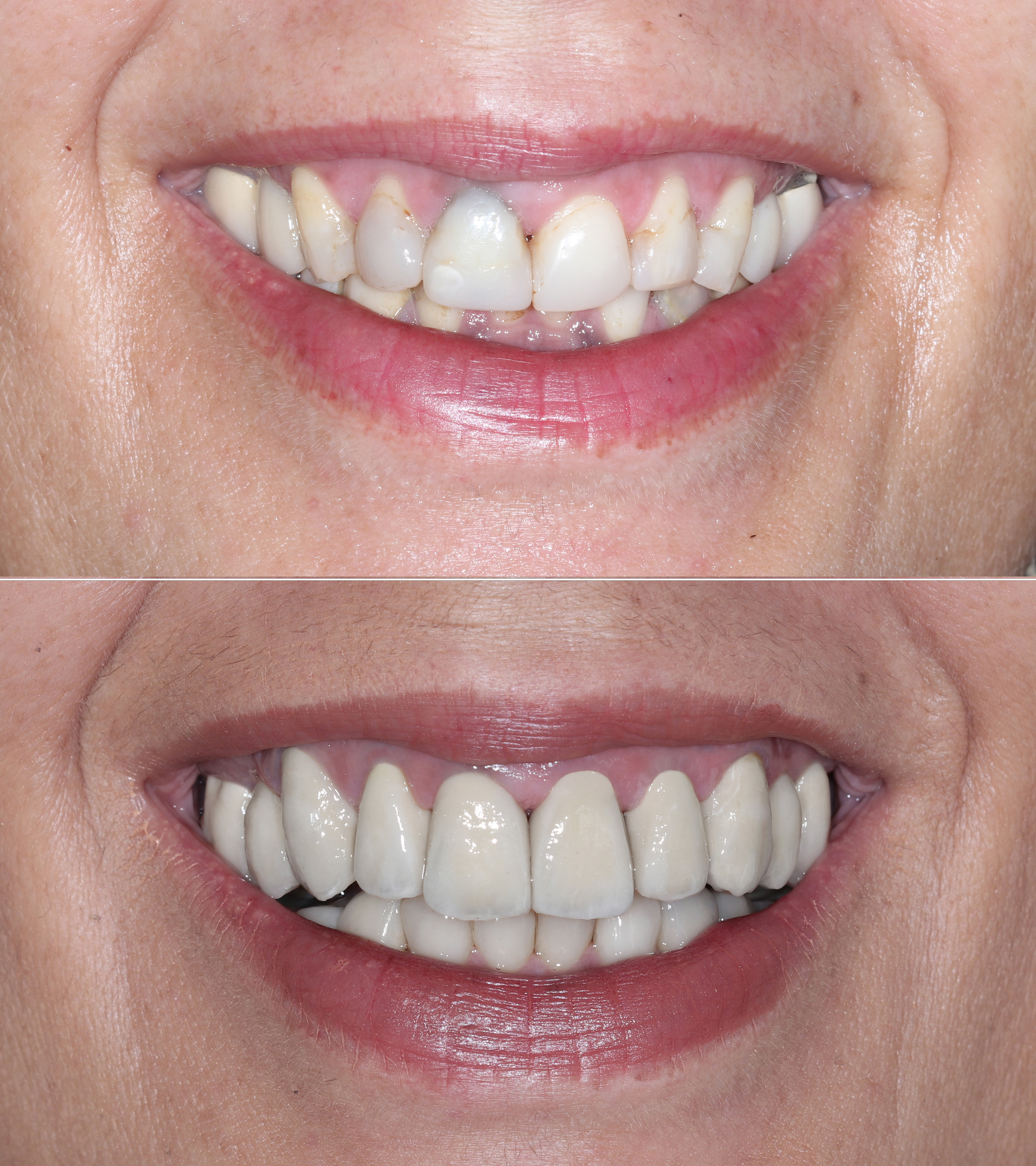 Σύγκριση αρχικής και τελικής κατάστασης – Χαμόγελο