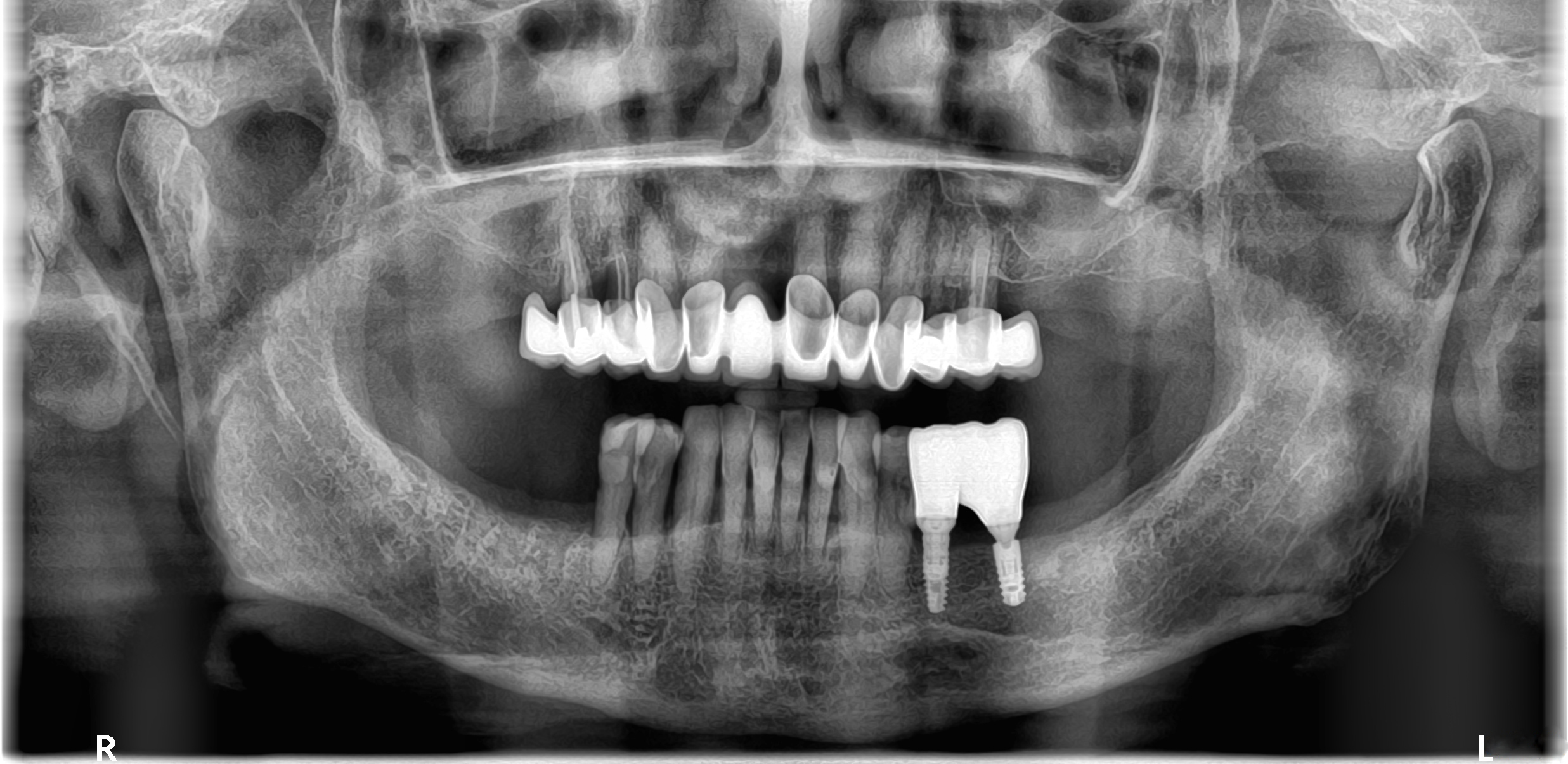 Αρχική κατάσταση - Πανοραμική ακτινογραφία -  Έλλειψη των κάτω δεξιά γομφίων