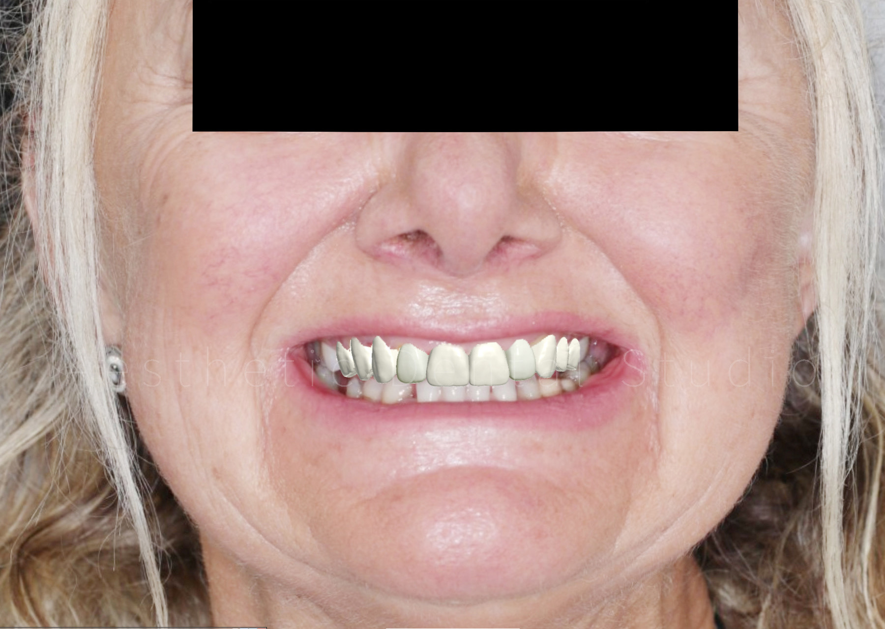 Από τον ψηφιακό σχεδιασμό στο τελικό αποτέλεσμα – 2o στάδιο – Ψηφιακή προσομοίωση Digital Smile Design