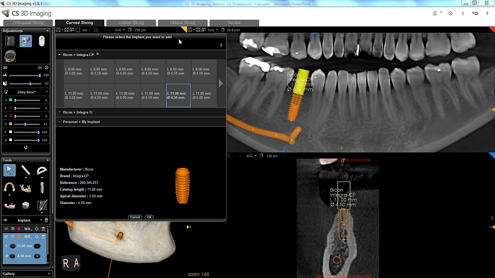 Ο σωστός ψηφιακός σχεδιασμ ός με CBCT και εξειδικευμένο λογισμικό αποτελεί βασικό παράγοντα επιτυχίας στα οδοντικά εμφυτεύματα, προσφέροντας ακρίβεια και προβλεψιμότητα στη θεραπεία.