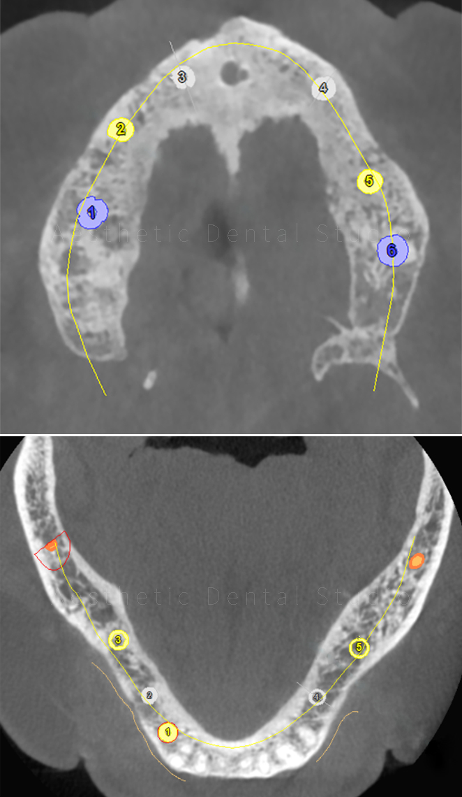 Προεγχειρητικός σχεδιασμός εμφυτευμάτων άνω και κάτω γνάθου — αξονικές τομές - καθορισμός ιδανικών θέσεων και γωνιών τοποθέτησης με βάση τον διαθέσιμο οστικό όγκο