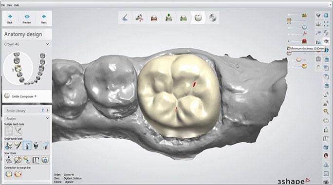 Η ψηφιακή οδοντιατρική CAD/CAM επιτρέπει στον Dr. Κληρονόμος να σχεδιάζει στεφάνες και αποκαταστάσεις υψηλής ακρίβειας με σύγχρονη τεχνολογία στην Καλαμάτα.