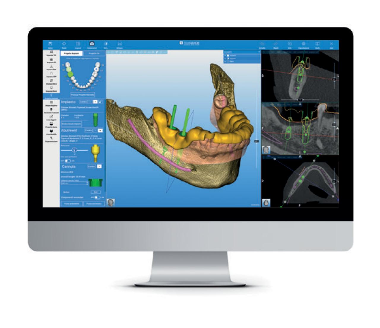 Ο ψηφιακός σχεδιασμός εμφυτευμάτων με CBCT και σύγχρονο λογισμικό βοηθά τον Dr. Κληρονόμος να επιτυγχάνει ακριβείς και προβλέψιμες θεραπείες εμφυτευμάτων.