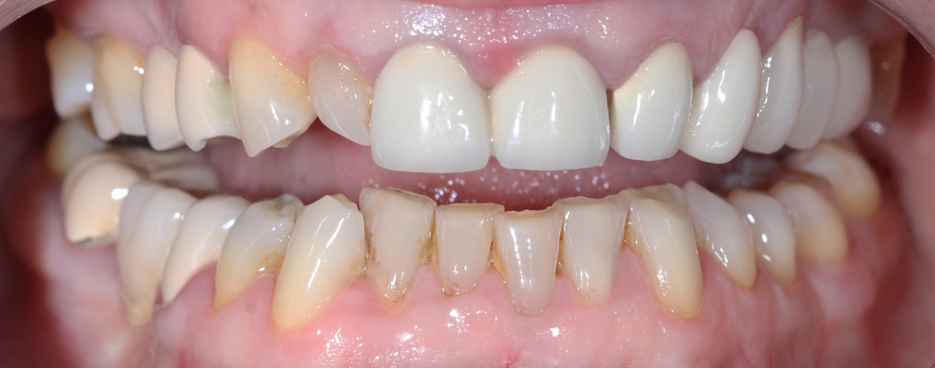 Αρχική κατάσταση - Πρόσθια άποψη (ελαφρώς ανοικτό στόμα).