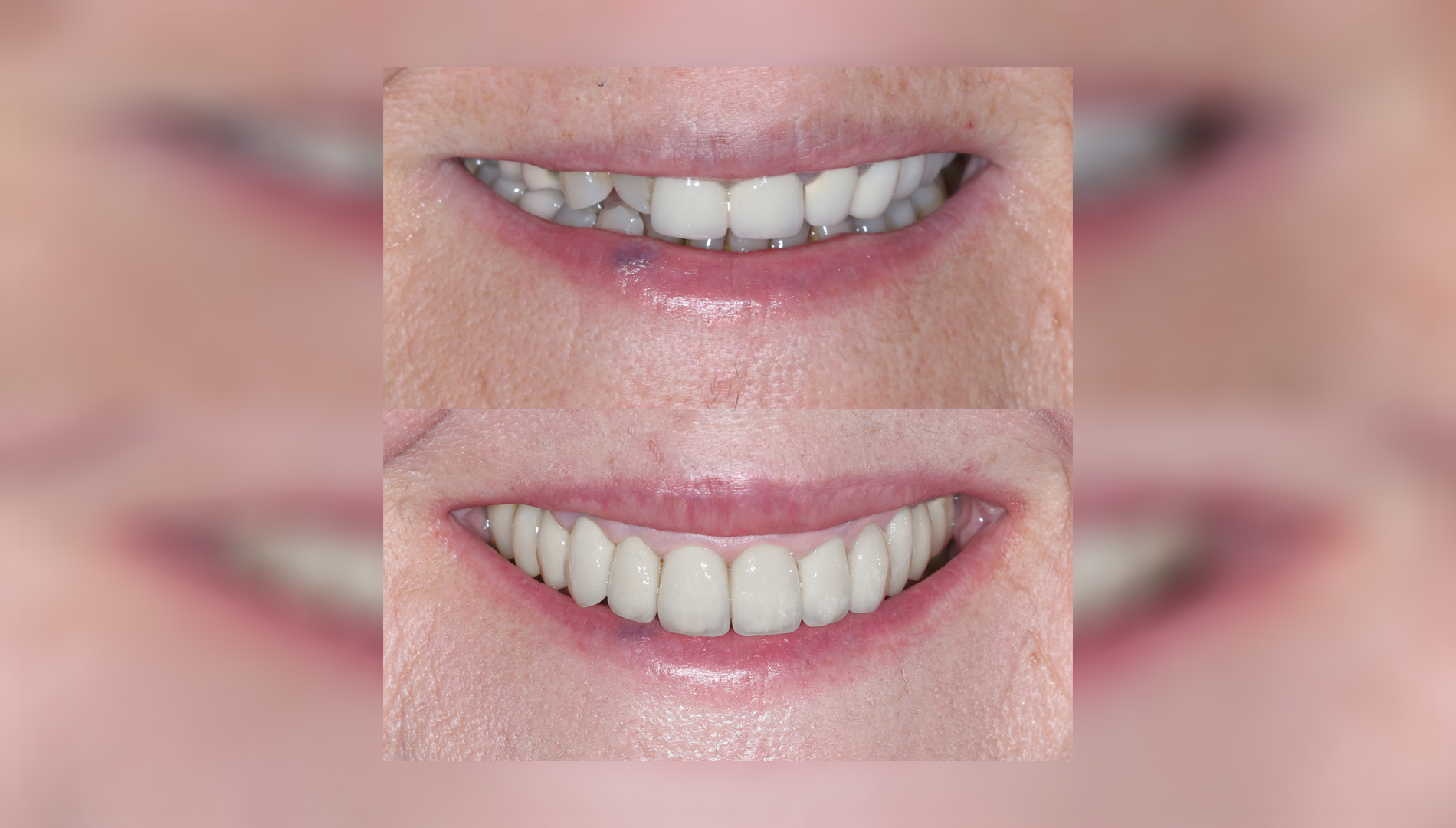 Full-mouth restoration with a combination of ceramic bridgework and composite veneers - Dr. Klironomos