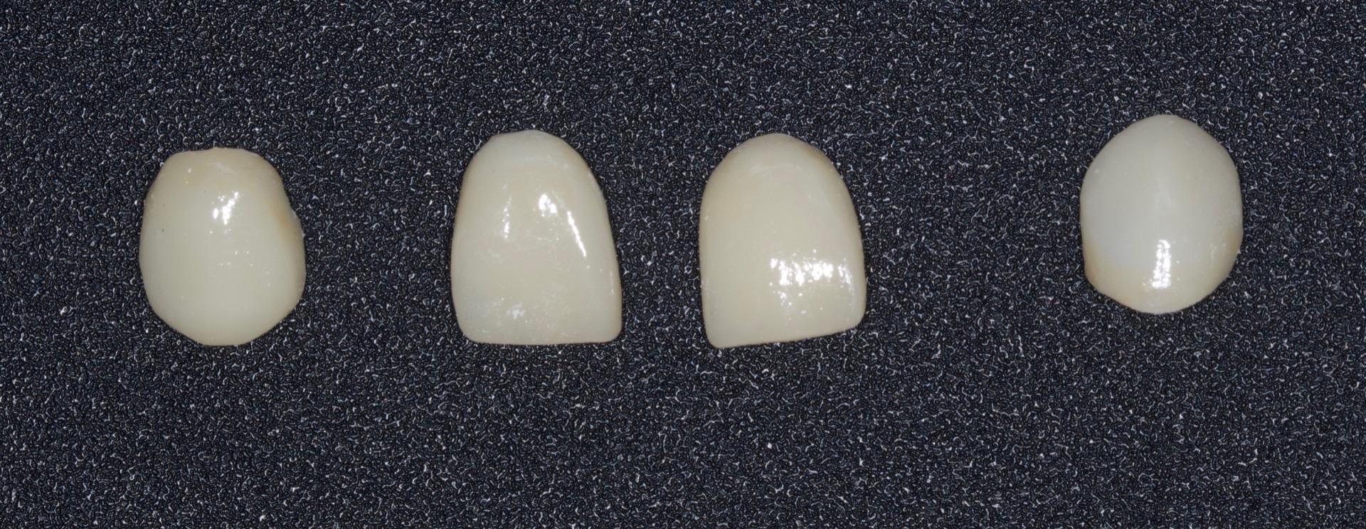 Οι ολοκεραμικές όψεις (διπυριτικού λιθίου) των άνω προσθίων δοντιών πριν την τοποθέτηση στο στόμα.