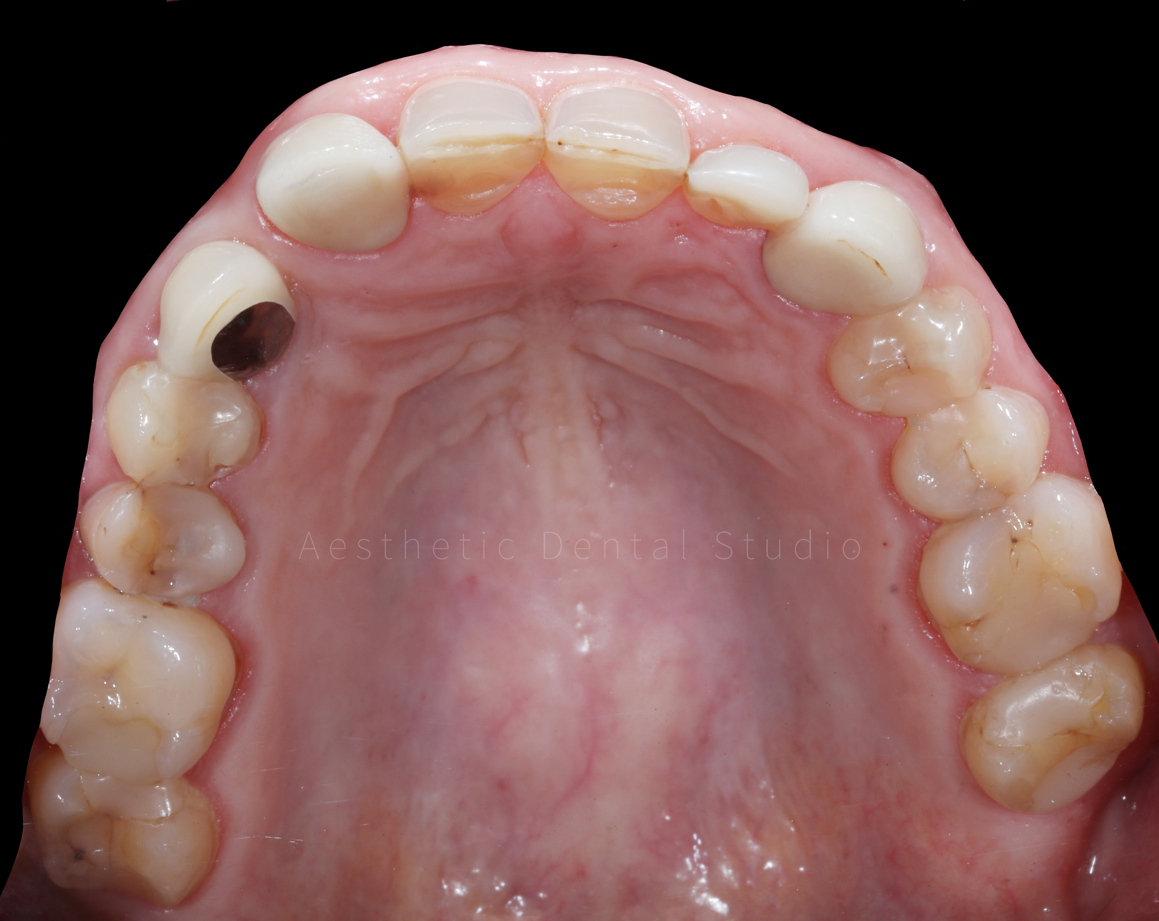 Αρχική ενδοστοματική εικόνα – Μασητική άποψη – Παλαιές αποκαταστάσεις, τερηδονισμένα και φθαρμένα δόντια
