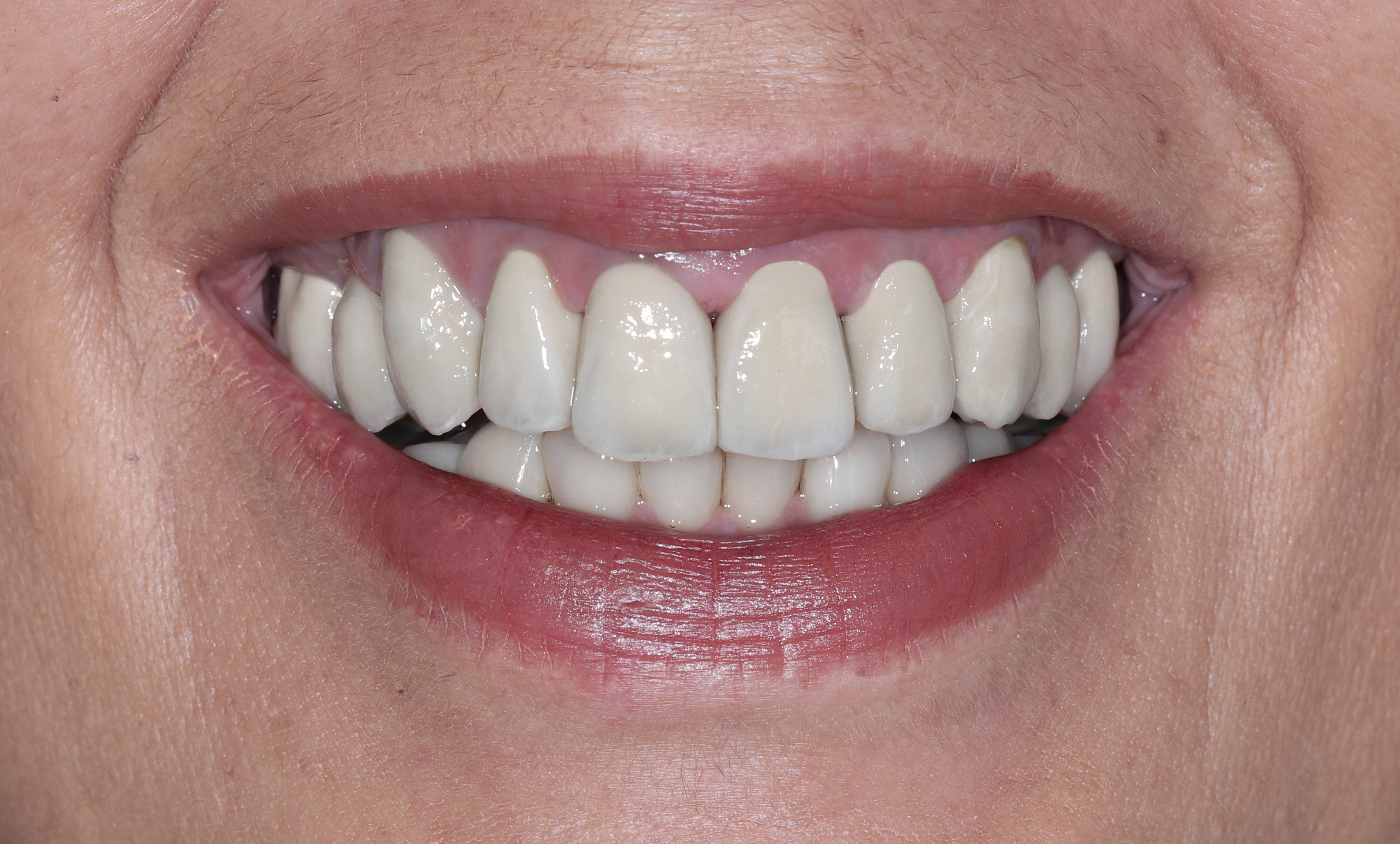 Χαμόγελο μετά την ολοκλήρωση της θεραπείας