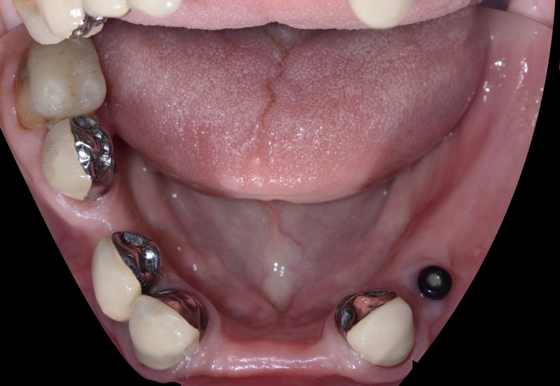 Τελική κατάσταση - Μασητική άποψη κάτω γνάθου (χωρίς την μερική οδοντοστοιχία τοποθετημένη.