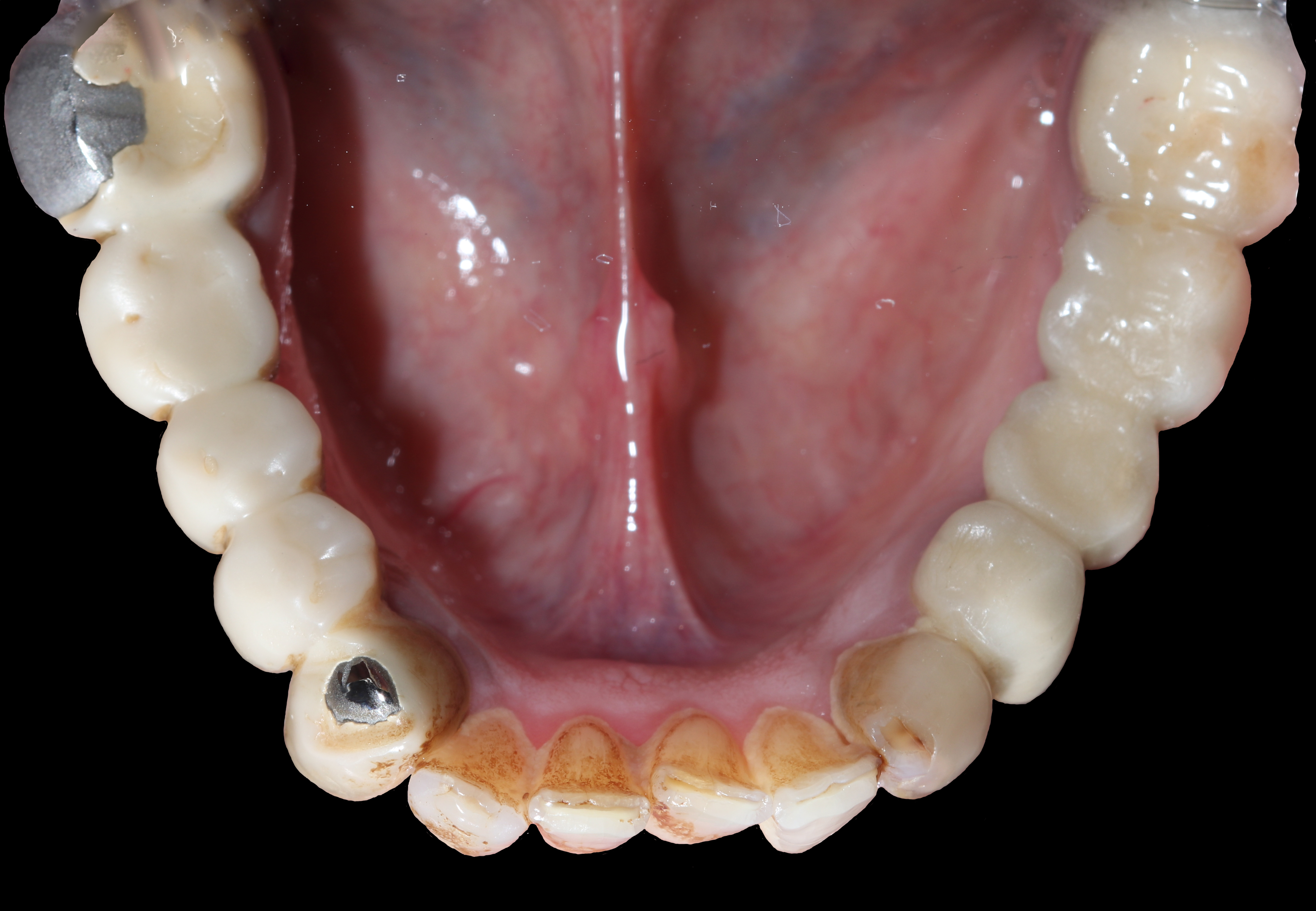 Κάτω γνάθος - Μασητική άποψη πριν την αισθητική αποκατάσταση