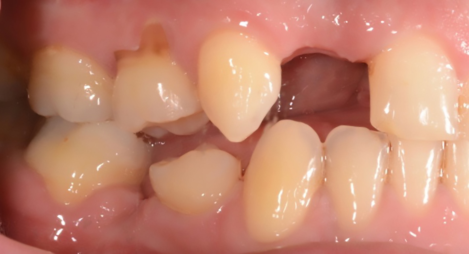 Αρχική κατάσταση - Δεξιά άποψη.