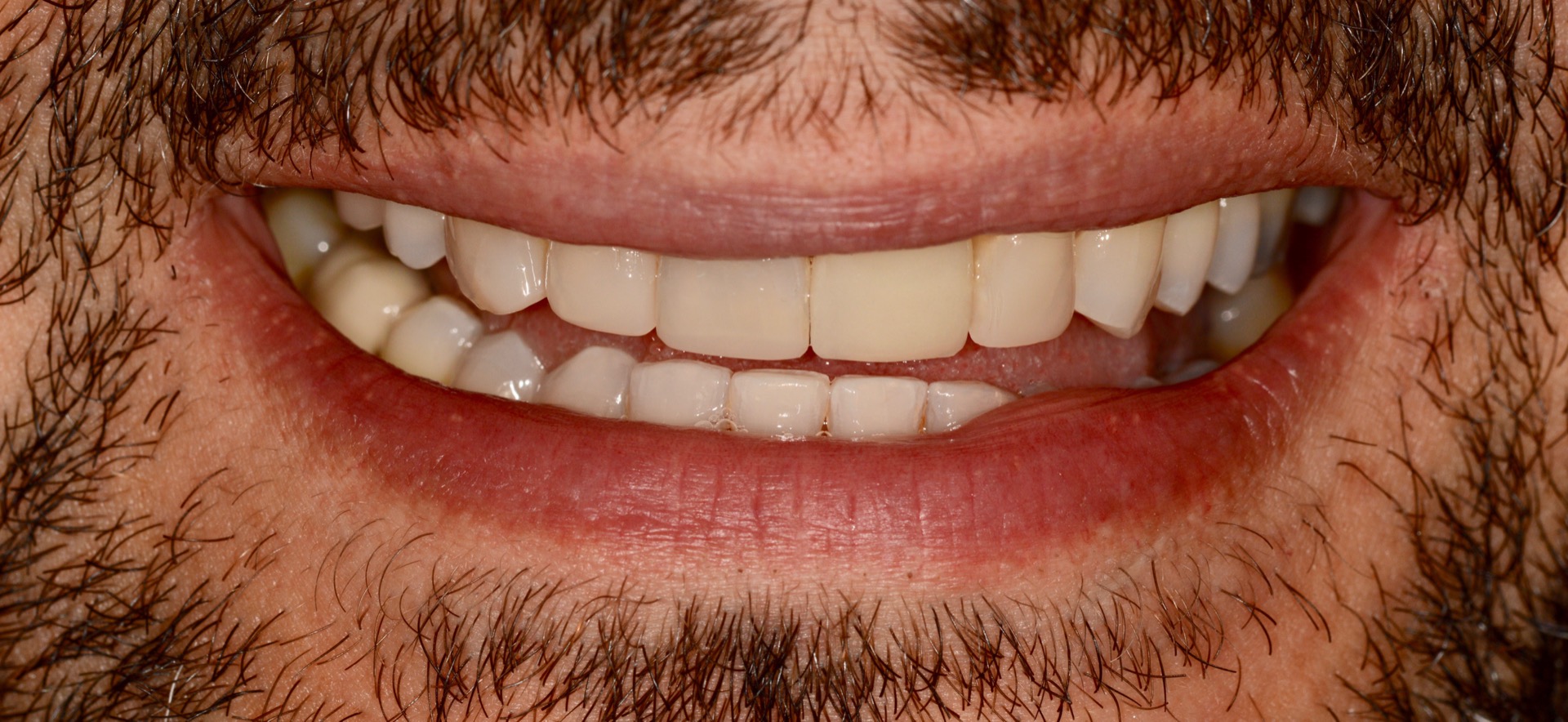 Τελική κατάσταση - Χαμόγελο - Η τελική στεφάνη διπυριτικού λιθίου τοποθετημένη στο στόμα.