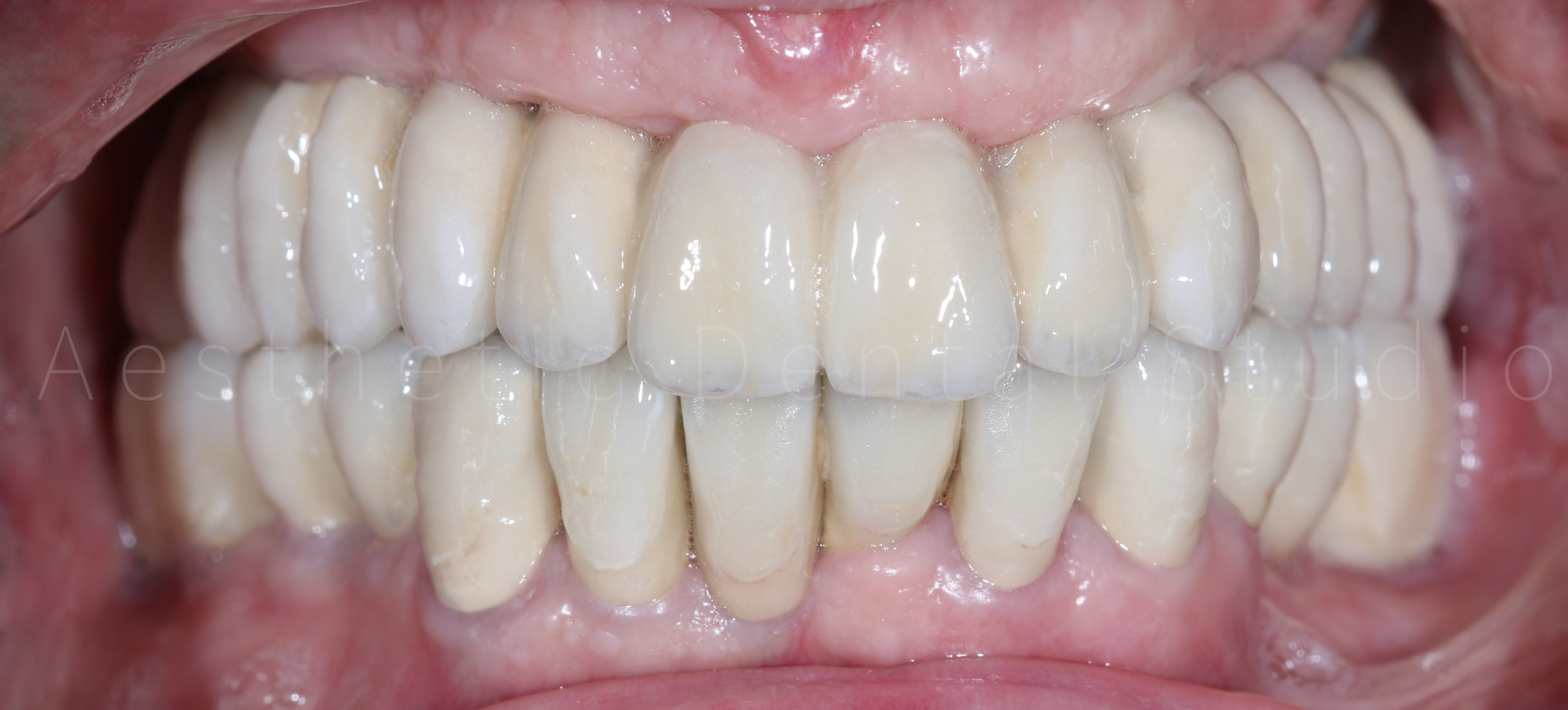 Τελική ενδοστοματική εικόνα — πλήρης αποκατάσταση με κεραμικές αποκαταστάσεις πάνω σε εμφυτεύματα και δόντια, με φυσική αισθητική και ιδανική σύγκλειση