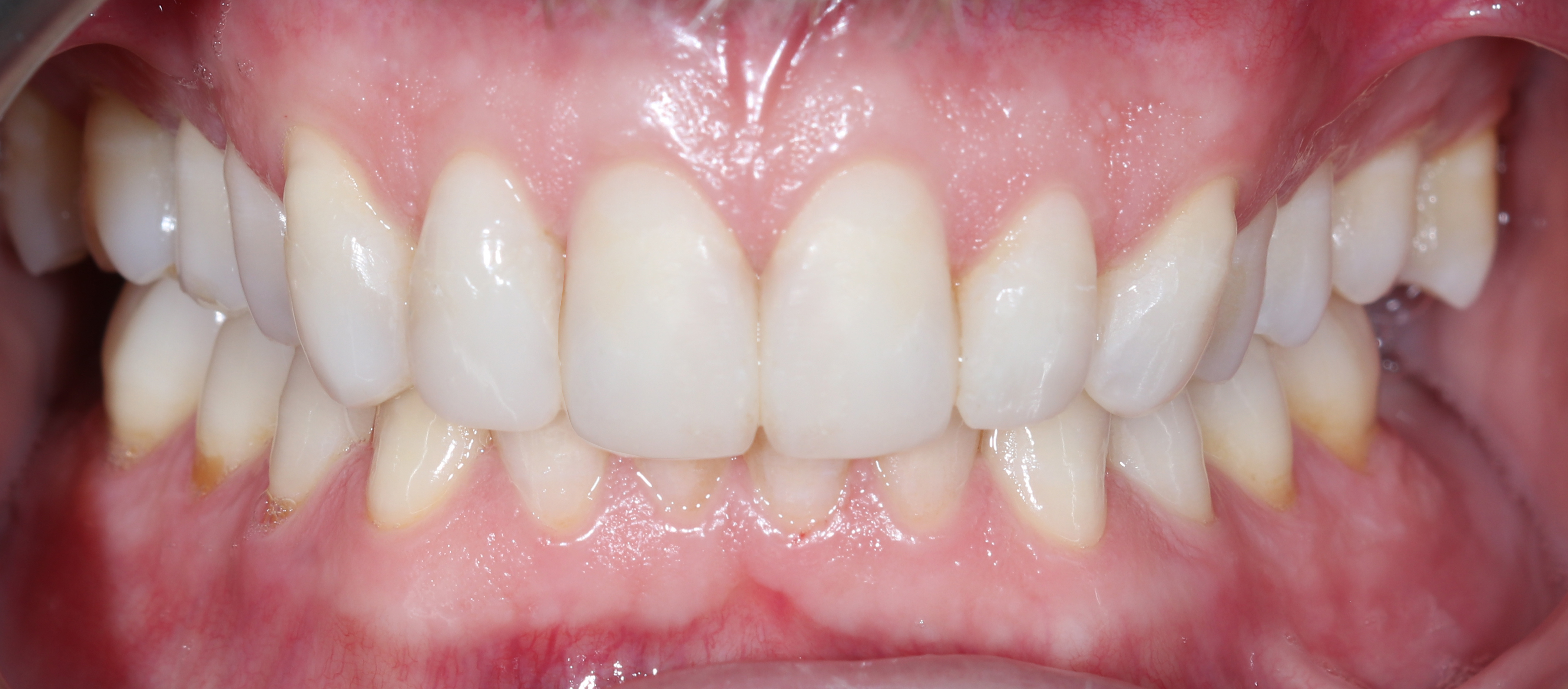 Πρόσθια όψη με τα δόντια σε σύγκλειση μετά την αποκατάσταση