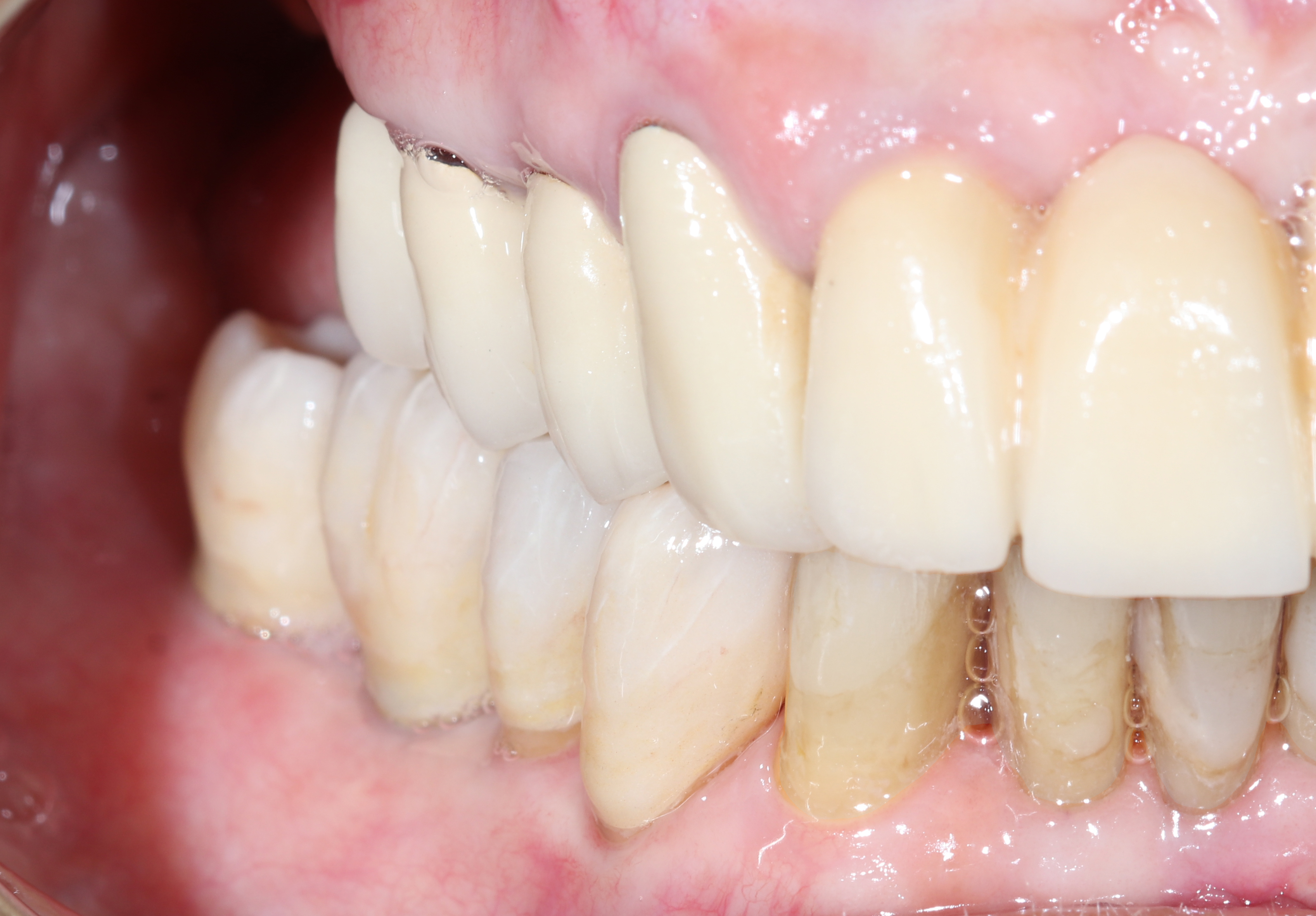 Τελική κατάσταση - Πλάγια άποψη