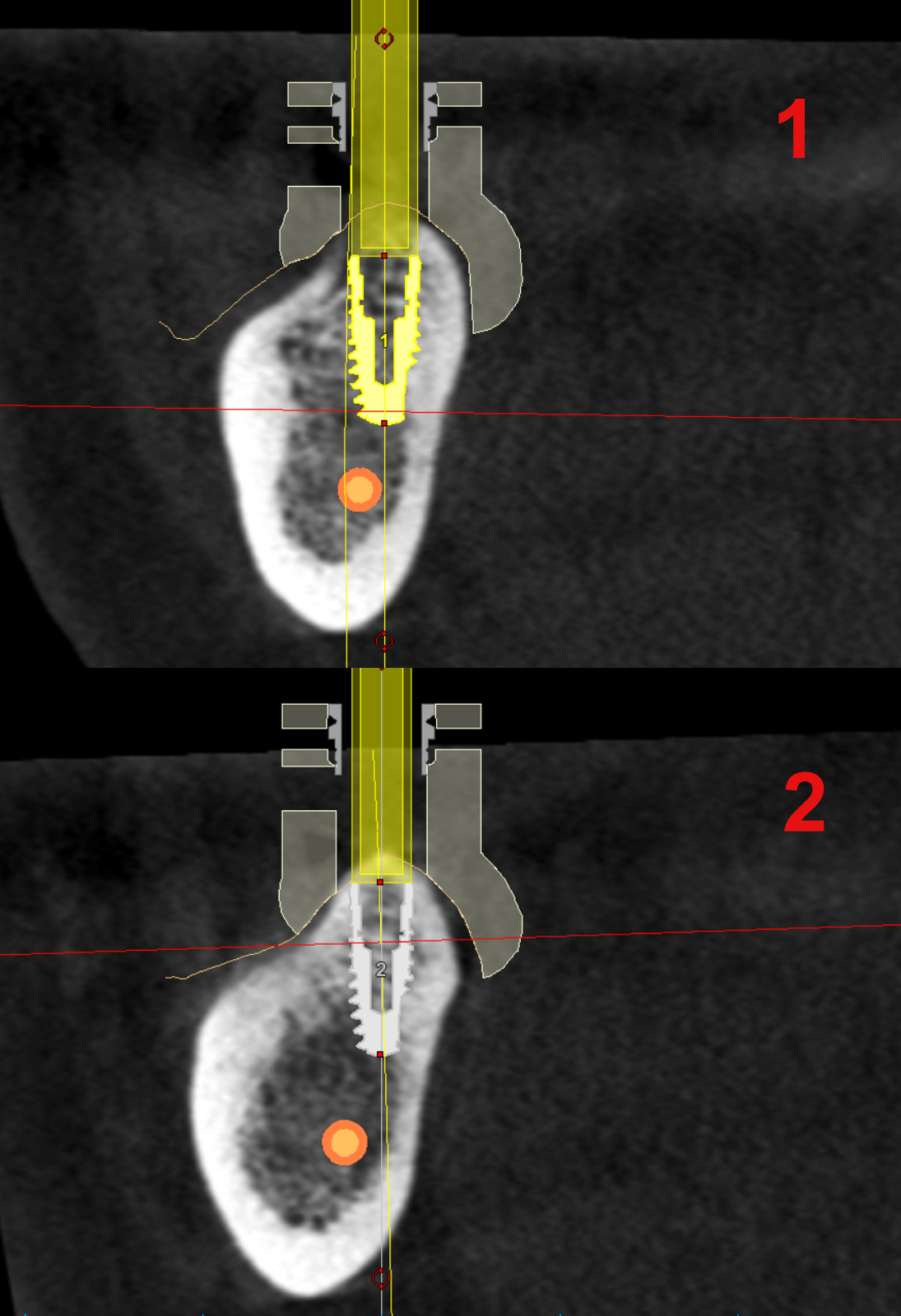 3D αξονική ακτινογραφία - Εγκάρσιες τομές της κάτω γνάθου της ασθενούς - Στιγμιότυπα από τα δύο εμφυτεύματα που έχουν τοποθετηθεί με την βοήθεια ειδικού οδοντιατρικού προεγχειρητικού λογισμικού. Μπορούμε να ελέγξουμε την θέση τους στο οστό, τον προσανατολισμό και τις κλίσεις μεταξύ τους, την πιθανή γειτνίαση με ανατομικά μόρια κ.ο.κ.
