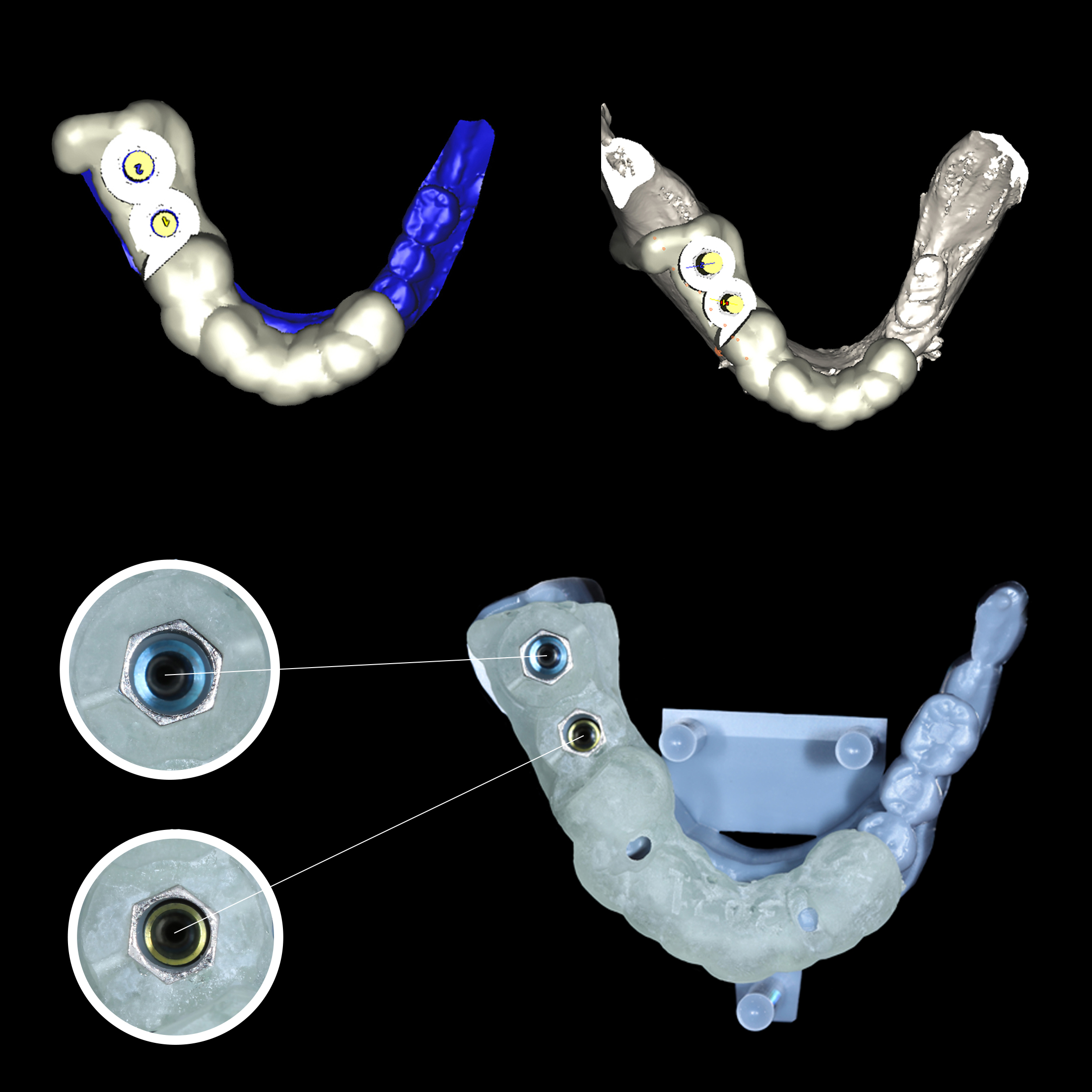 Επαλήθευση της θέσης των εμφυτευμάτων σύμφωνα με τον προεγχειρητικό ψηφιακό σχεδιασμό - Πάνω: Στιγμιότυπα από το λογισμικό σχεδιασμού, με τα εμφυτεύματα τοποθετημένα ψηφιακά στη γνάθο της ασθενούς πριν από τη χειρουργική επέμβαση.
Κάτω: Ο χειρουργικός νάρθηκας τοποθετημένος στο τρισδιάστατα εκτυπωμένο μοντέλο των κάτω δοντιών, μετά την επούλωση και την ψηφιακή αποτύπωση.
Παρατηρείται απόλυτη ταύτιση των οπών του νάρθηκα με τον επιμήκη άξονα των εμφυτευμάτων εξασφαλ ίζοντας 100% χειρουργική ακρίβεια