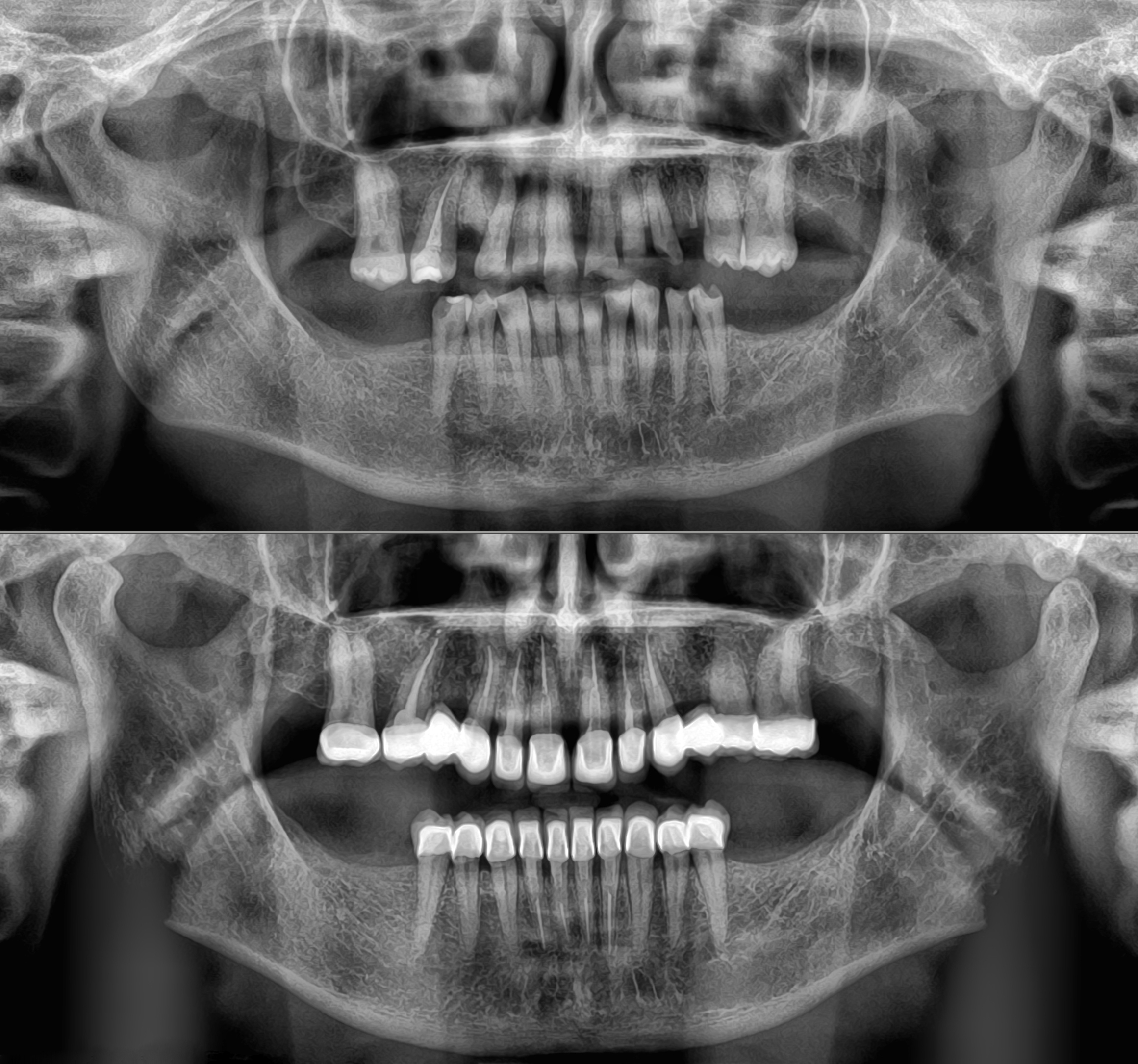 Σύγκριση αρχικής και τελικής κατάστασης – Πανοραμικές ακτινογραφίες που αποτυπώνουν την πορεία και το τελικό αποτέλεσμα της θεραπείας