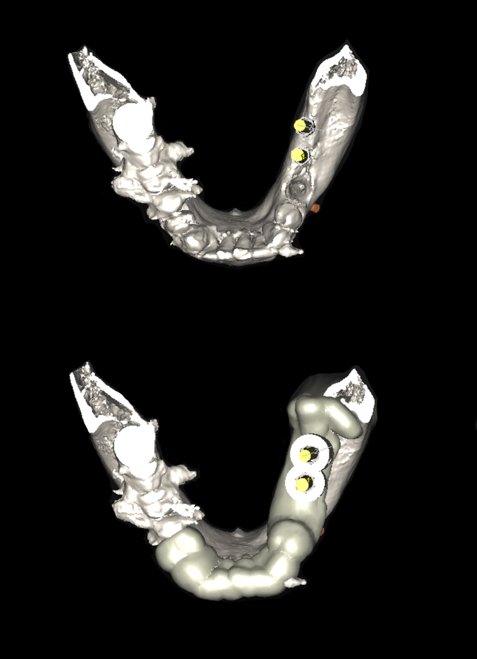 3D αξονική ακτινογραφία - Πάνω: το τρισδιάστατο μοντέλο της κάτω γνάθου με τα δύο εμφυτεύματα ψηφιακά τοποθετημένα - Κάτω: ο χειρουργικός «οδηγός», ο οποίος είναι ειδικά σχεδιασμένος για το στόμα της ασθενούς μας. Αφου εκτυπωθεί, θα χρησιμοποιηθεί για την τοποθέτηση των εμφυτευμάτων με α�κρίβεια χιλιοστού, όπως ακριβώς έχει σχεδιαστεί εδώ
